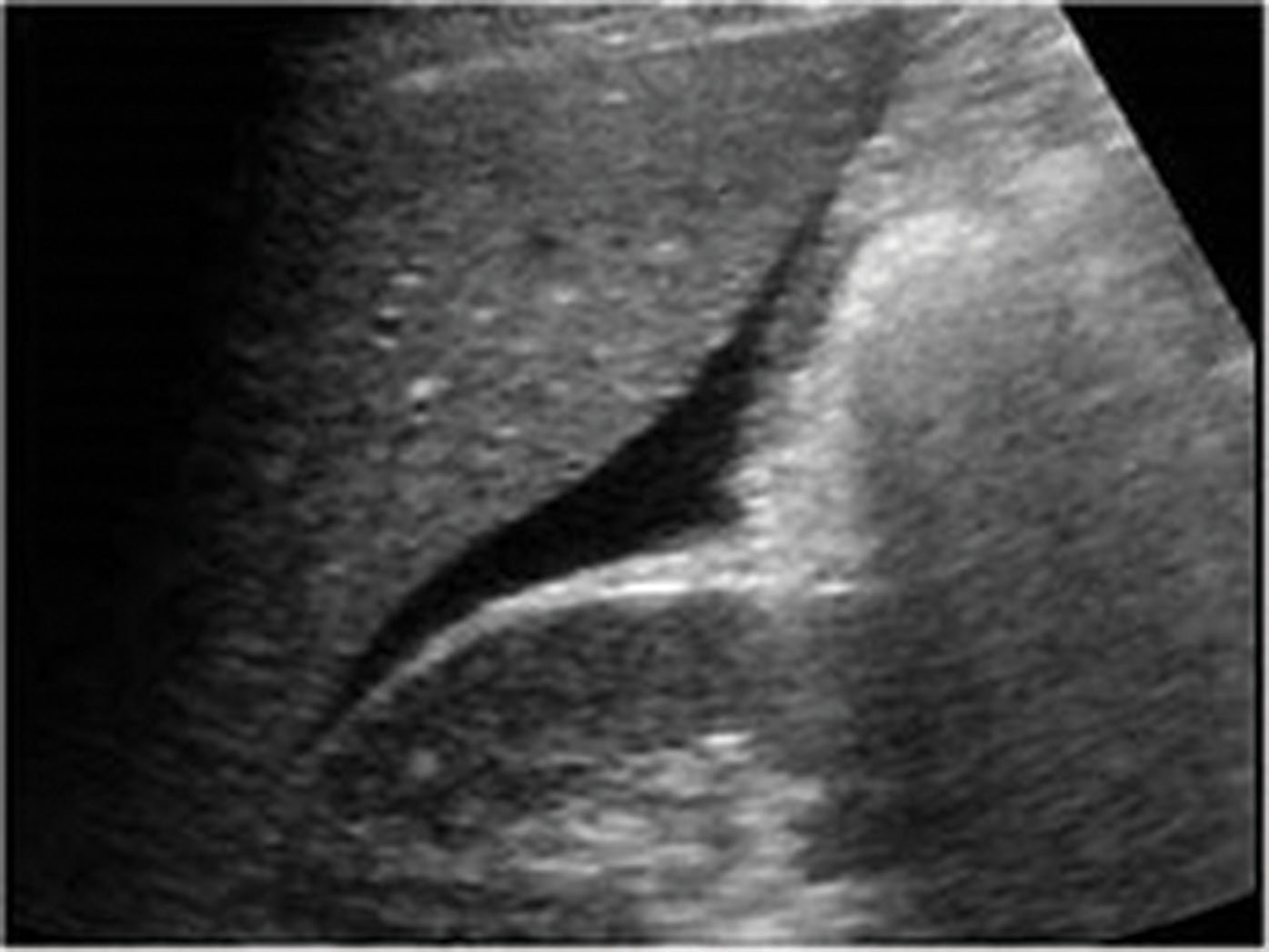 Fig. 19.9, The most common site of fluid accumulation is the subhepatic space (Morison’s pouch), regardless of the site of the injury.