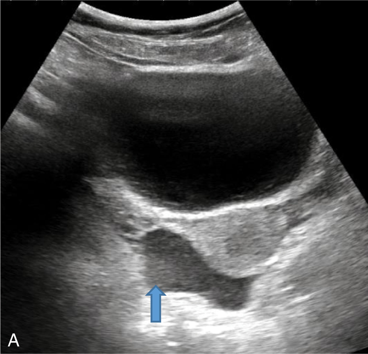 Fig. 19.10, Transverse (A) and longitudinal (B) images of free fluid in the pouch of Douglas (arrows) . The blood in the pelvis may collect centrally in the pouch of Douglas or laterally in the paravesical space.