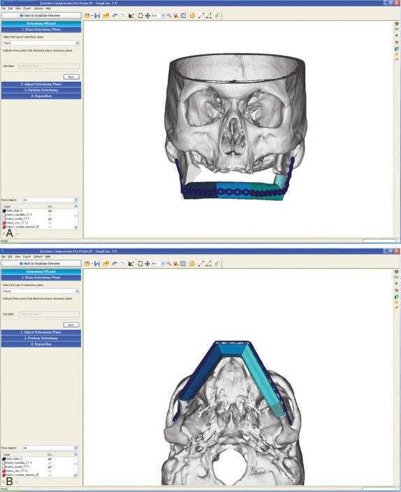 Figure 4.1, Computer-assisted design virtual reconstruction of the mandible with a fibula free flap in (A) anterior-posterior and (B) submental views. The head can be rotated in any direction to confirm that the planned reconstruction is ideal in terms of restoring the patient's mandibular shape and occlusion.