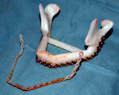 Figure 4.2, A 3-dimensional rapid prototype model made of acrylic polymer that can be used to guide surgery as well as act as a template for bending titanium hardware, which can be done preoperatively to save time, then sterilized in preparation for surgery.