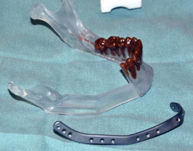 Figure 4.4, A custom-made titanium plate based on the preoperative virtual plan next to a 3-dimensional mandible model. The plate is created using a computer-guided milling process rather than by printing for increased strength. The screw hole placement and angulation is defined by the surgeon during computer planning.