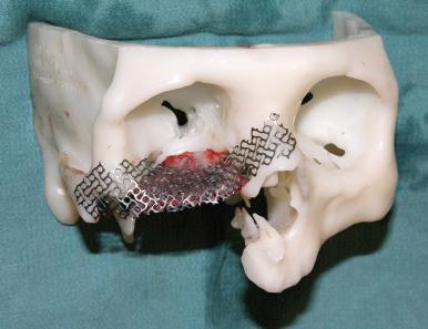 Figure 4.5, A 3-dimensional model used to guide orbital reconstruction with titanium mesh and bone graft for accurate restoration of the orbital floor, which is critical to prevent enophthalmos, exophthalmos, and/or orbital dystopia.