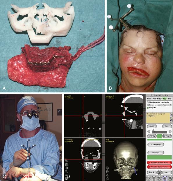 Figure 4.6, (A) Midfacial reconstruction with a fibula free flap using a rapid prototype model to guide shaping. (B) Inset of the flap is performed transorally, without facial incisions. Correct flap positioning prior to rigid fixation is confirmed using stereotactic navigation, which requires a fixed array so that the system can locate the facial skeleton in 3-dimensional space. (C) A handheld probe is used to confirm that the flap is in the planned position. (D) The tip of the probe can be located on the patient's computed tomography (CT) scan in multiple planes. Note the virtual fibula flap has been superimposed on the CT scan images.