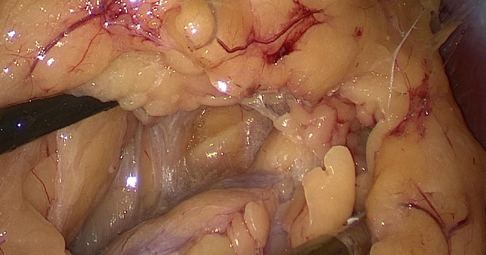 Fig. 15.2, During a left retroperitoneoscopic adrenalectomy, images are provided with a magnified, high-definition view of the operating field.