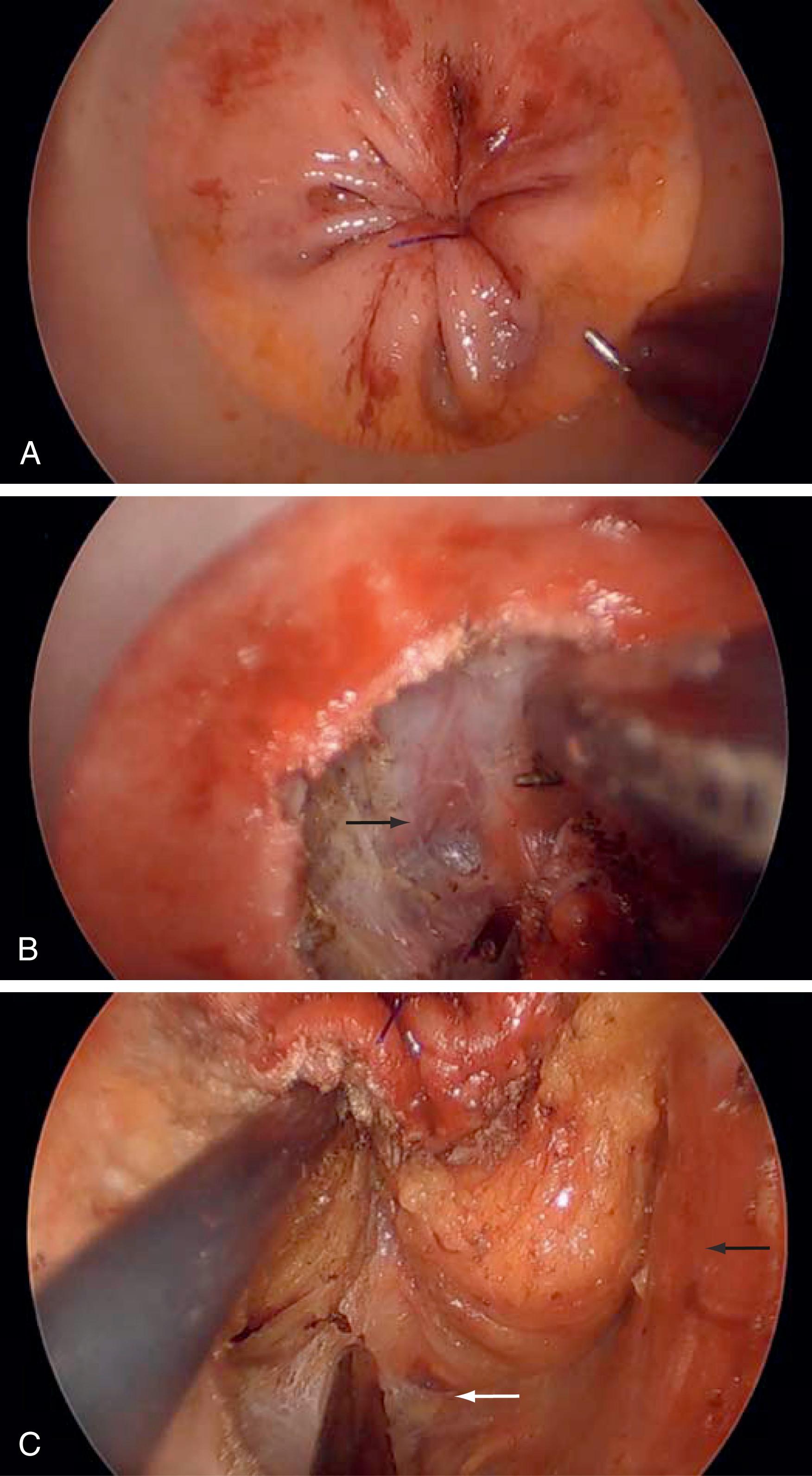 Fig. 15.3, Transanal total mesorectal excision (TaTME): TME dissection from the perineal approach using an advanced endoscopic operating platform. (A) Rectal purse-string closure from transanal view. (B) Dissection of the anterior plane. The black arrow points to the TME plane between the prostate and mesorectum. (C) Dissection of the posterior plane. The white arrow points to the TME plane between the mesorectum and pelvic floor. The hatched arrow demonstrates the levator ani.
