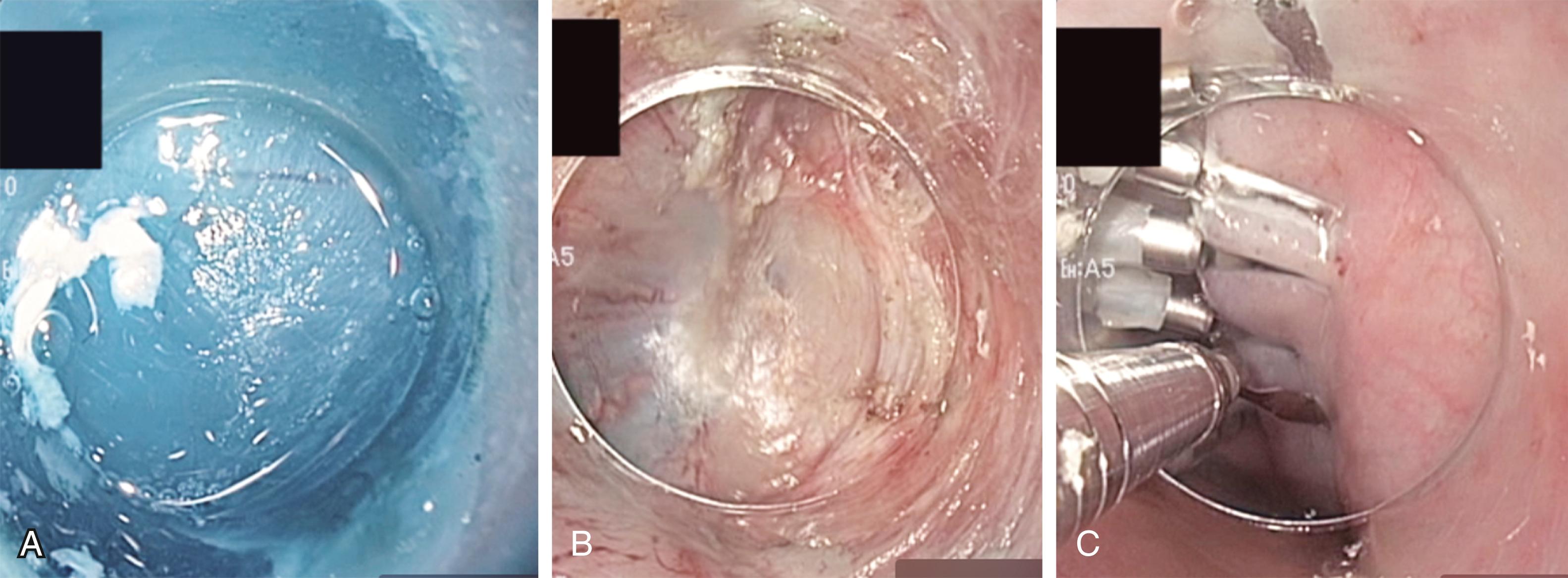 Fig. 15.4, Peroral endoscopic myotomy. (A) View of the endoscopic submucosal tunnel after an incision is made in the mucosa. (B) Almost complete myotomy with only a few circular muscle fibers remaining to be divided. (C) Closure of mucosal incision with clips.