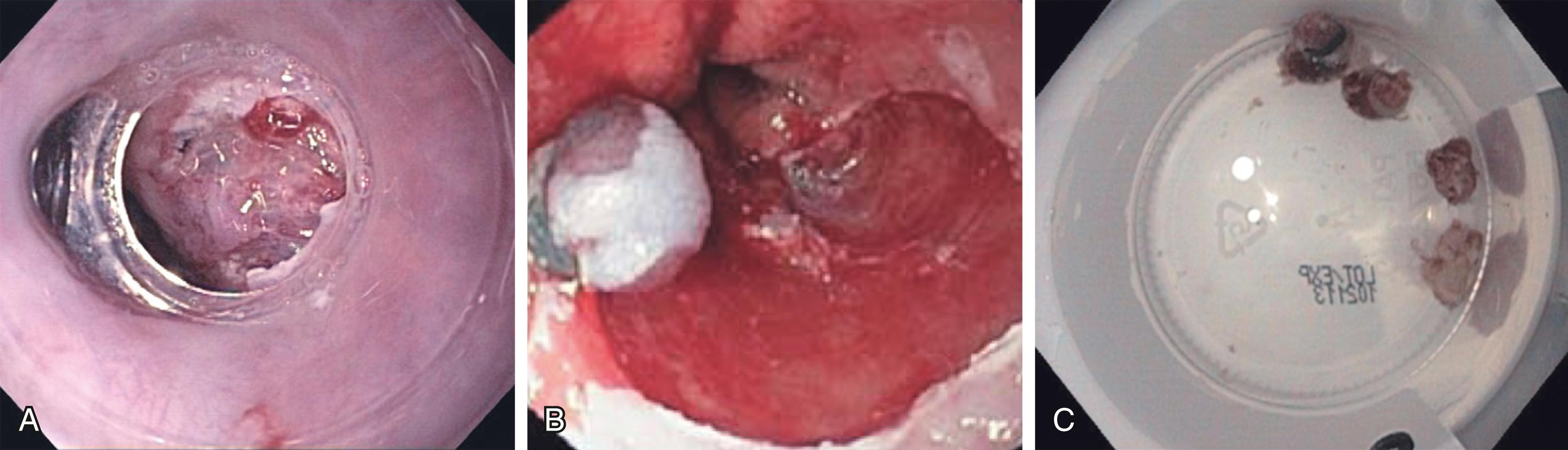 Fig. 15.5, Endoscopic mucosal resection. (A) View of the target lesion through the endoscopic cap. (B) Target lesion is raised off the underlying tissues by submucosal injection and banded to create a pseudopolyp, which is removed by a technique similar to snare polypectomy. (C) Large lesions must be removed piecemeal using this technique.