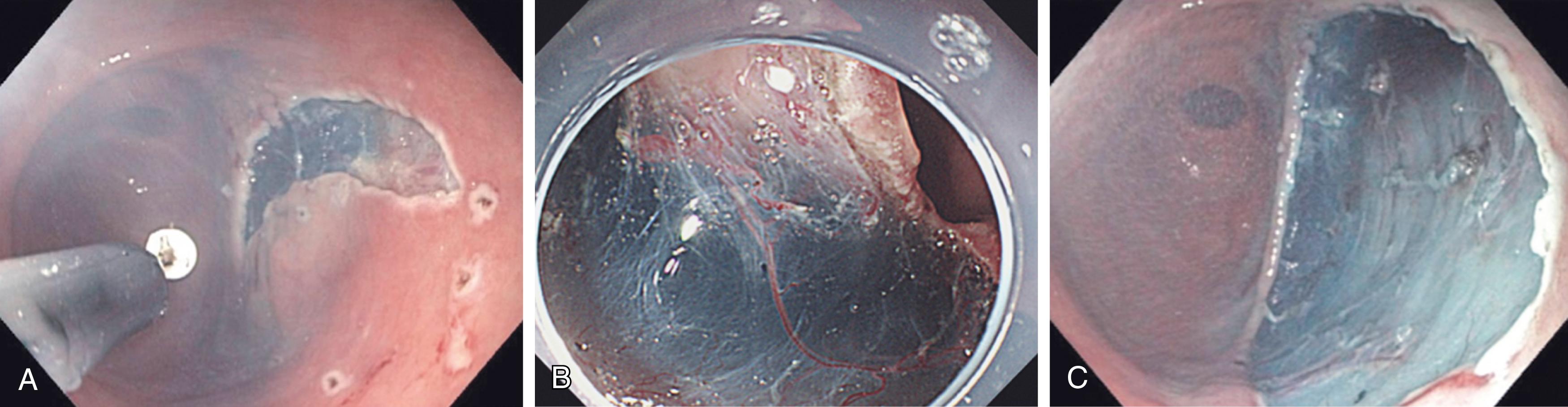 Fig. 15.6, Endoscopic submucosal dissection. (A) The target lesion is mapped out with radiofrequency energy and raised off the underlying tissues through submucosal injection. The mucosa is then circumferentially cut around the target lesion. (B) The mucosal lesion is dissected from the submucosa. (C) The resulting mucosal defect after en bloc removal of the target lesion.