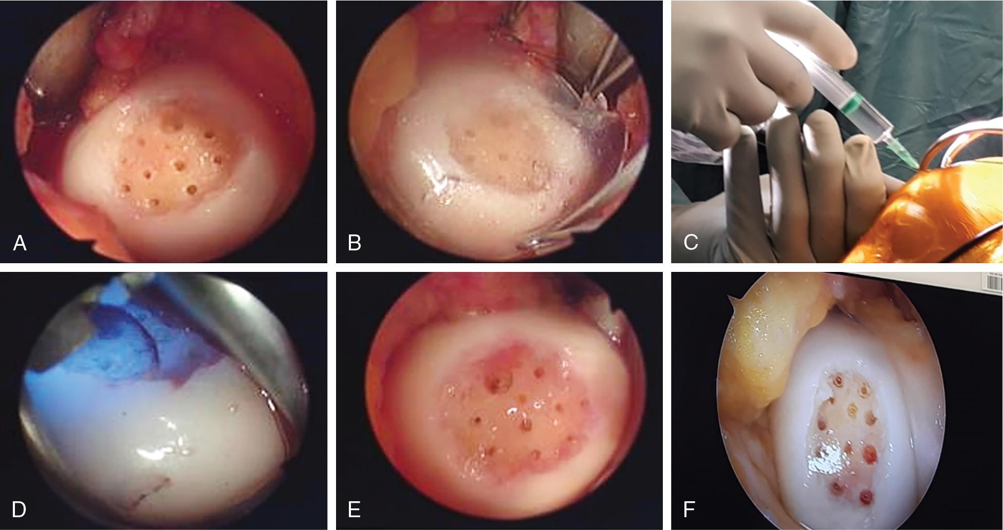 Fig. 75.3, The Gelrin C Technique. (A) Marrow stimulation with microfractures. (B) Application of a sealant. (C) Injection of the Gelrin C hydrogel in its liquid-gel form. (D) The defect with the Gelrin C scaffold is exposed to UVA. (E) The Gelrin C following UVA exposure forms a semi-solid dense hydrogel matrix. (F) The semi-solid hydrogel creates a stable scaffold construct within the defect.