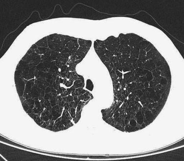 FIG. 20.1, Emphysema. High-resolution computed tomography shows hyperinflated lungs with extensive emphysematous changes.