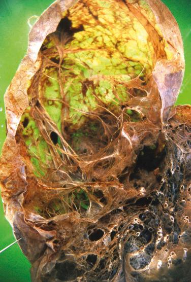 FIG. 20.2, Emphysema. This inflated formalin-fixed lung demonstrates severe emphysema with bullae.