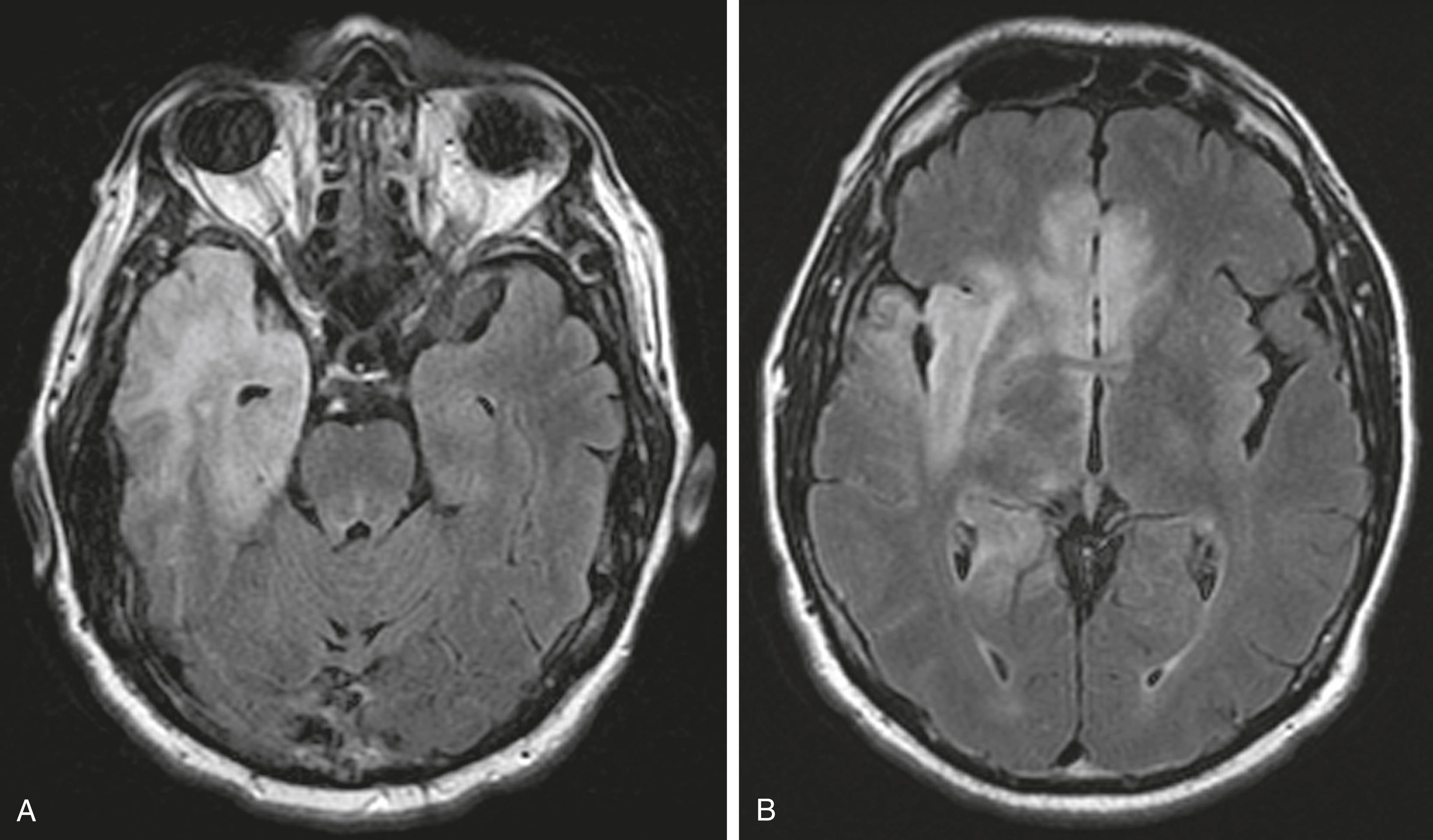 FIGURE 383-1, Magnetic resonance imaging (MRI) in herpes simplex encephalitis.