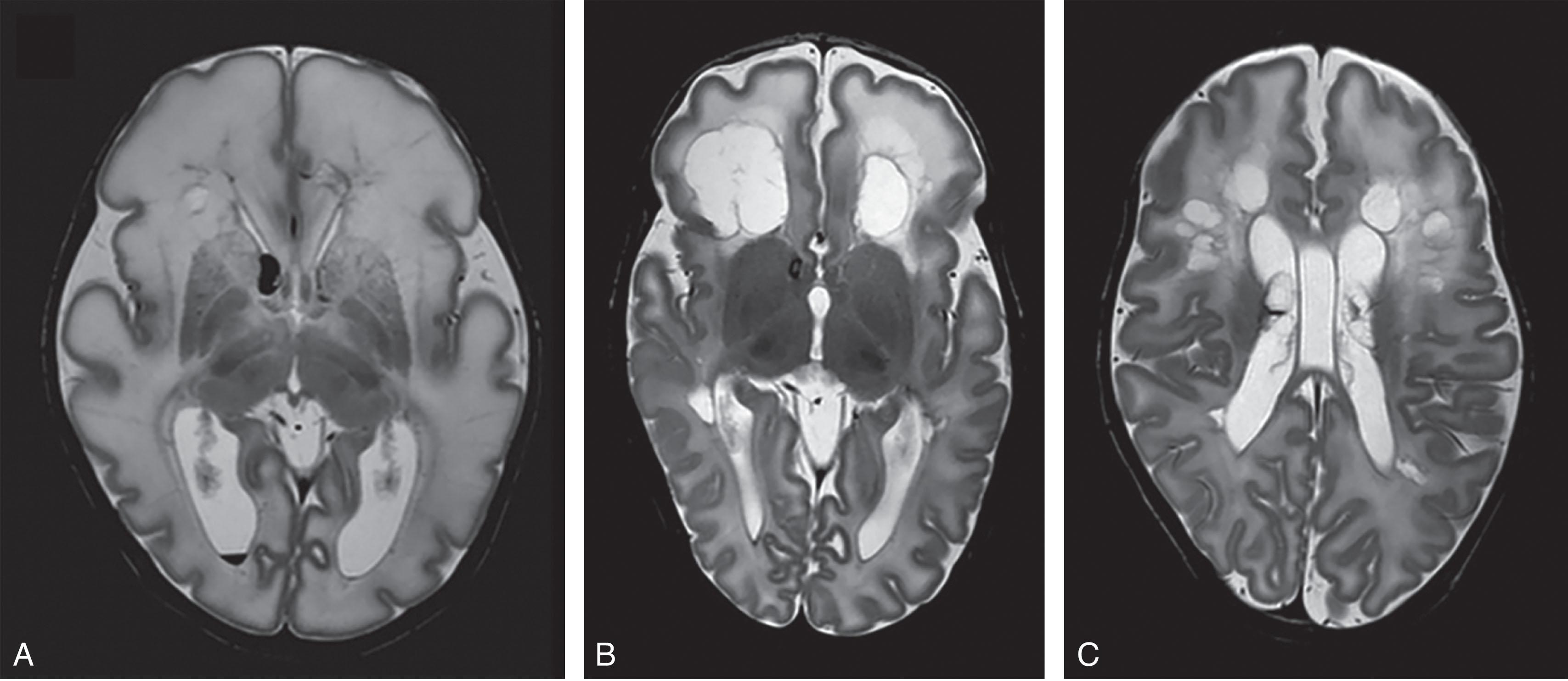 Fig. 20.11, MRI of the same infant. Transverse T 2 -weighted sequences on day 9 (A) and at term equivalent age. The MRI on day 9 (A) shows high signal intensity throughout the white matter and a single cyst in the right frontal lobe and the right occipital horn. There is blood in the germinal matrix. At term equivalent age (B), (C) very large cysts have developed, especially in the frontal lobes. The signal intensity is still increased in the frontal lobes.