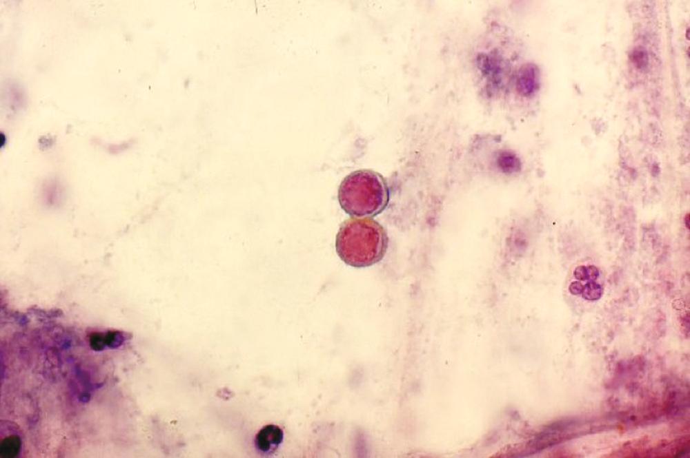 FIGURE 308-1, Papanicolaou stain of sputum showing a thick-walled yeast with broad-based budding typical of Blastomyces dermatitidis .