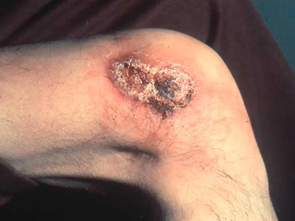 FIGURE 308-2, Skin lesion—blastomycosis.