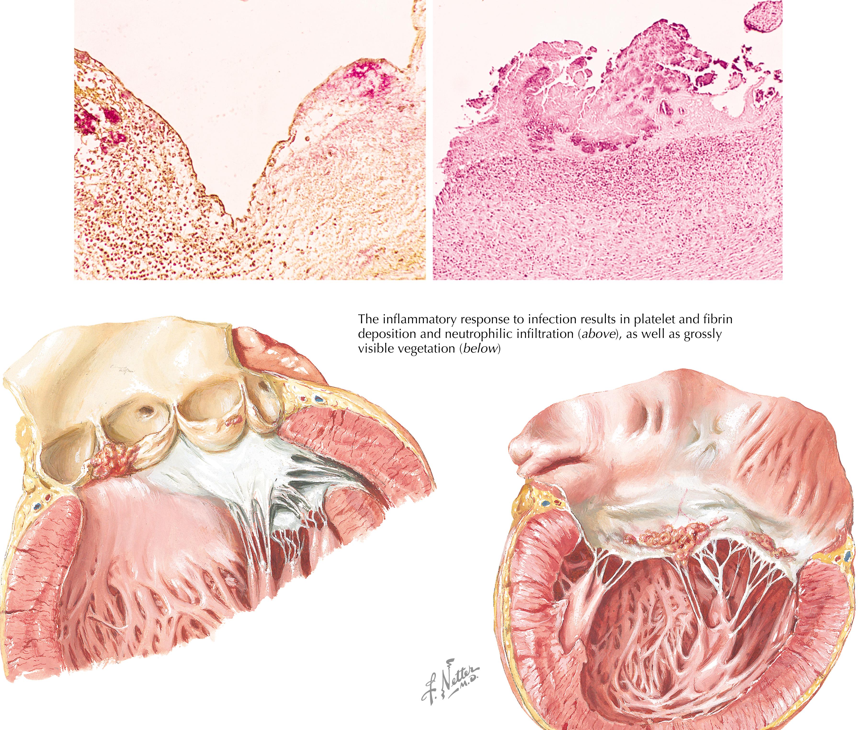 Fig. 36.1, Bacterial endocarditis: early lesions.