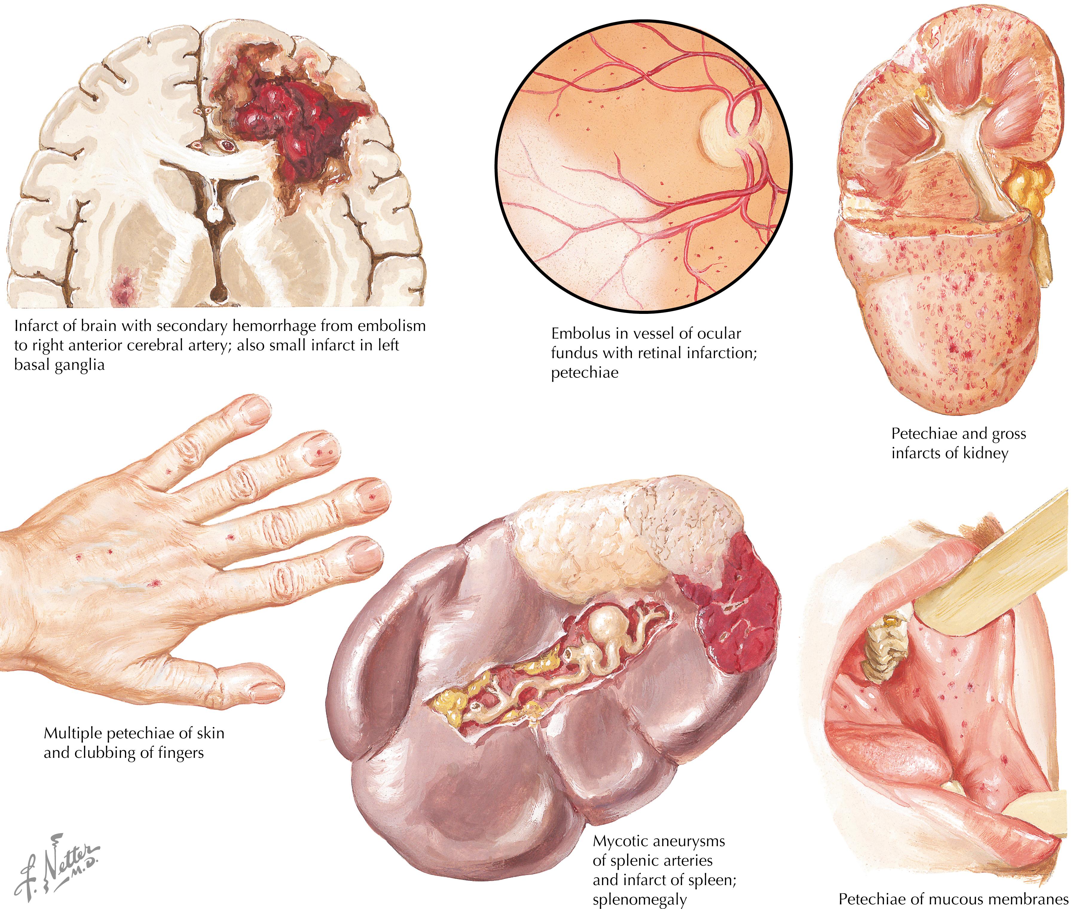 Fig. 36.2, Bacterial endocarditis: remote embolic effects.