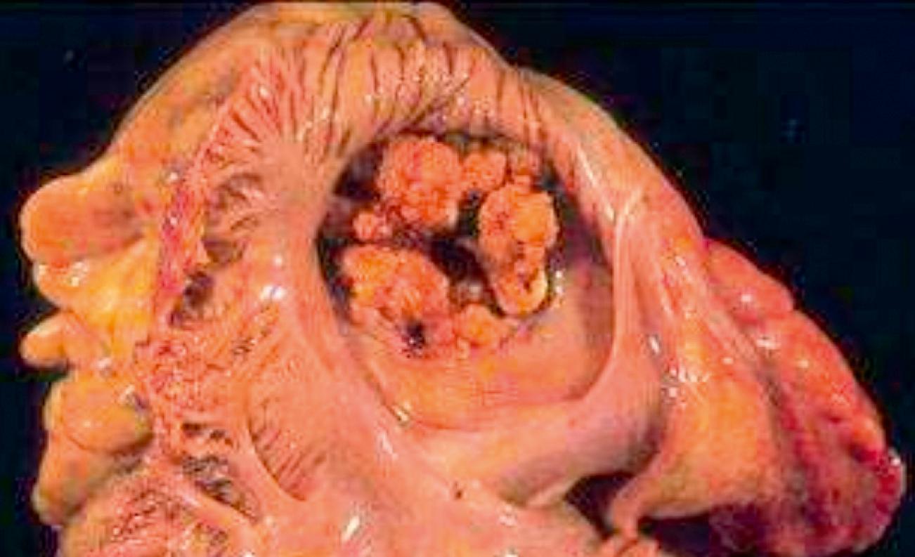 FIGURE 37.1, Infective endocarditis of the surface of the mitral valve. Note the healing masses at 10:00 and 2:00; this is “subacute” endocarditis with healing granulation tissue and fibrosis microscopically. No exophytic acute vegetation is present.