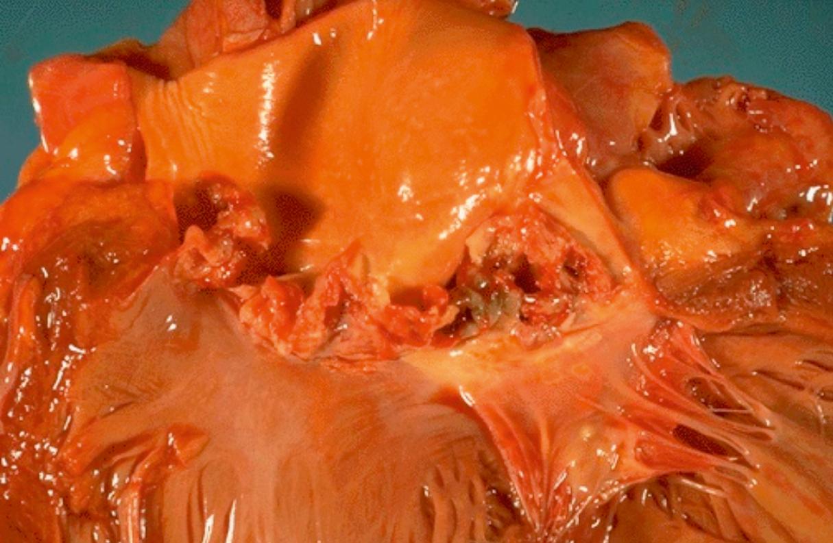 FIGURE 37.2, Infective endocarditis of the aortic valve. The left ventricular outflow tract is below the severely damaged valve, and the aorta is above. The anterior leaflet of the mitral valve is to the right and below the aortic valve. The aortic valve leaflets are almost entirely destroyed by the multiple vegetations of acute endocarditis.