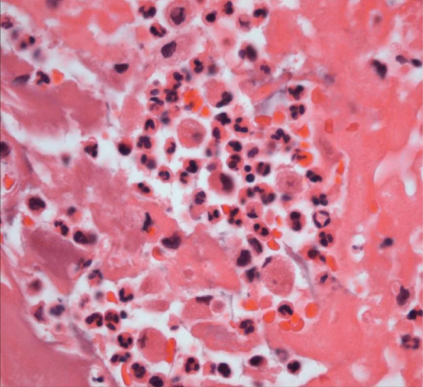 FIGURE 37.3, The histopathology of infective endocarditis. Vegetations are composed of neutrophils, macrophages, and fibrin ( red ). Organisms are present in acute, untreated endocarditis.