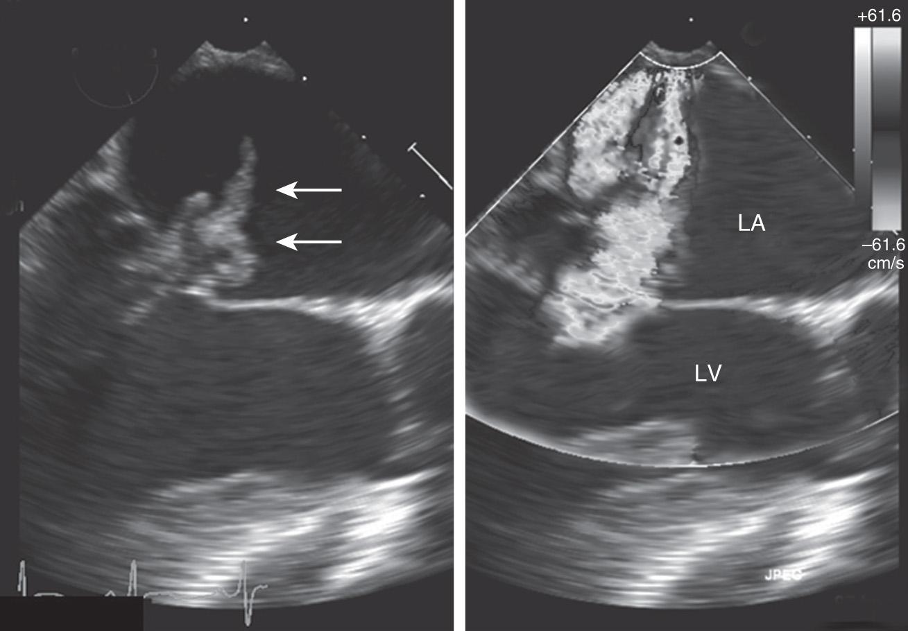 Fig. 34.2, Transesophageal echocardiography imaging showing endocarditis on the mitral valve. The left panel shows a large vegetation (arrows) on the mitral valve. The right panel shows the resultant severe mitral regurgitation. A large turbulent jet of blood is demonstrated going from the left ventricle (LV) , across the damaged mitral valve, into the left atrium (LA) .