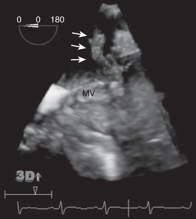 Fig. 34.3, Three-dimensional (3D) transesophageal echo showing large vegetation (arrows) on the mitral valve (MV).