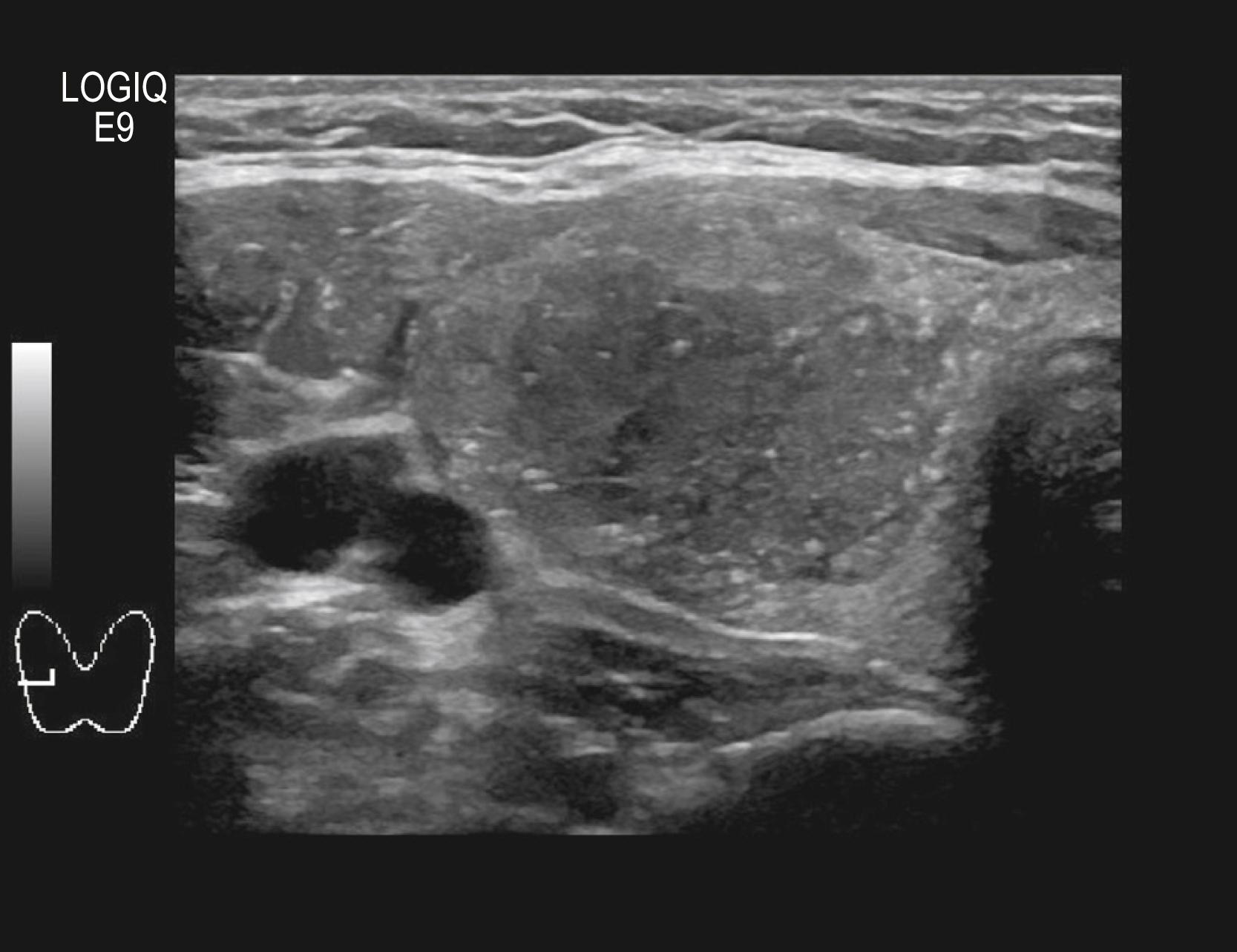 Fig. 75.2, A teenager presented with a large right thyroid mass that was found to be papillary cancer. Ultrasound features that are suggestive of thyroid malignancy include hypoechogenicities, irregular margins, and increased intranodular blood flow.