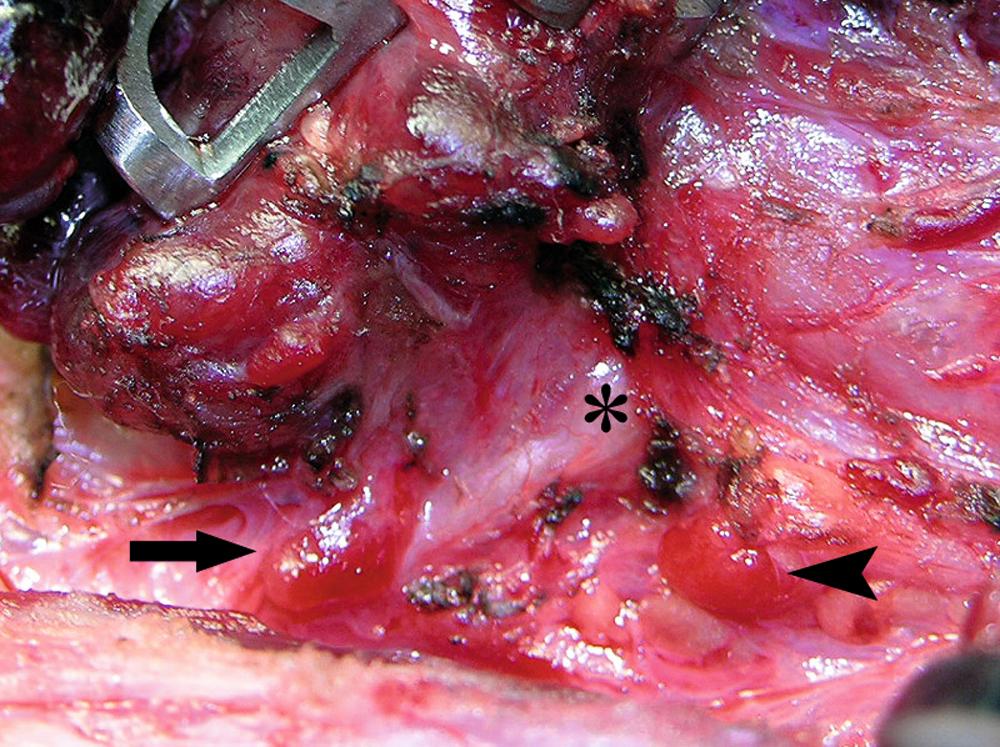 Fig. 75.4, The relationship of the parathyroid glands to the recurrent laryngeal nerve during prophylactic thyroidectomy for MEN type 2 is seen. The left recurrent laryngeal nerve is marked by an asterisk. The superior parathyroid gland (arrowhead) is typically located posterior to the nerve. The inferior parathyroid gland (arrow) is usually found anterior to the nerve.