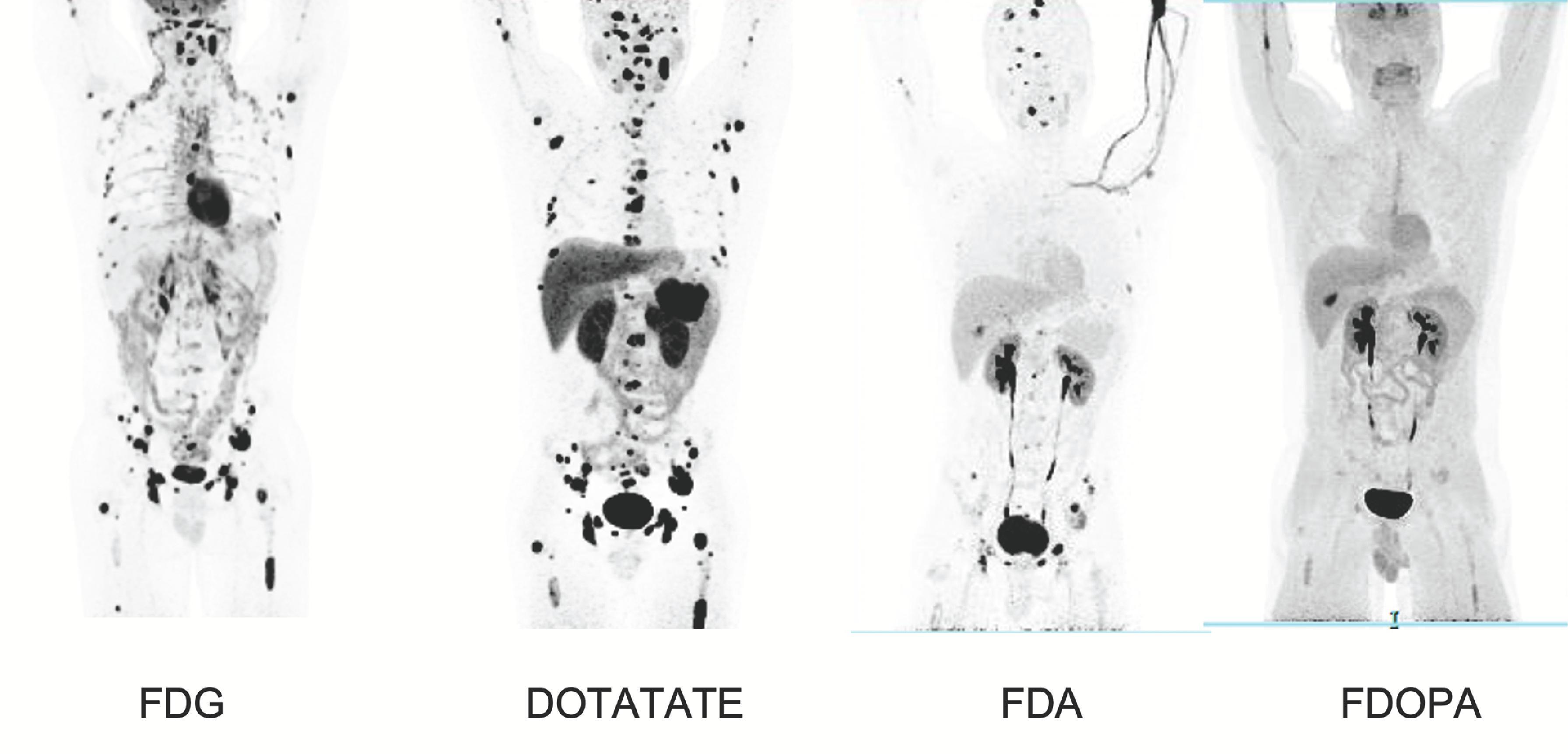 FIG. 2, Functional imaging in a patient with metastatic and recurrent pheochromocytoma. 18 F-fluorodeoxyglucose (FDG), 68 Ga-DOTATATE, 18 F-fluorodopamine (FDA), and 18 F-3,4-dihydroxyphenylalanine (FDOPA). The DOTATATE imaging shows the greatest number of metastatic lesions followed by FDG and FDA, and none is seen on FDOPA.
