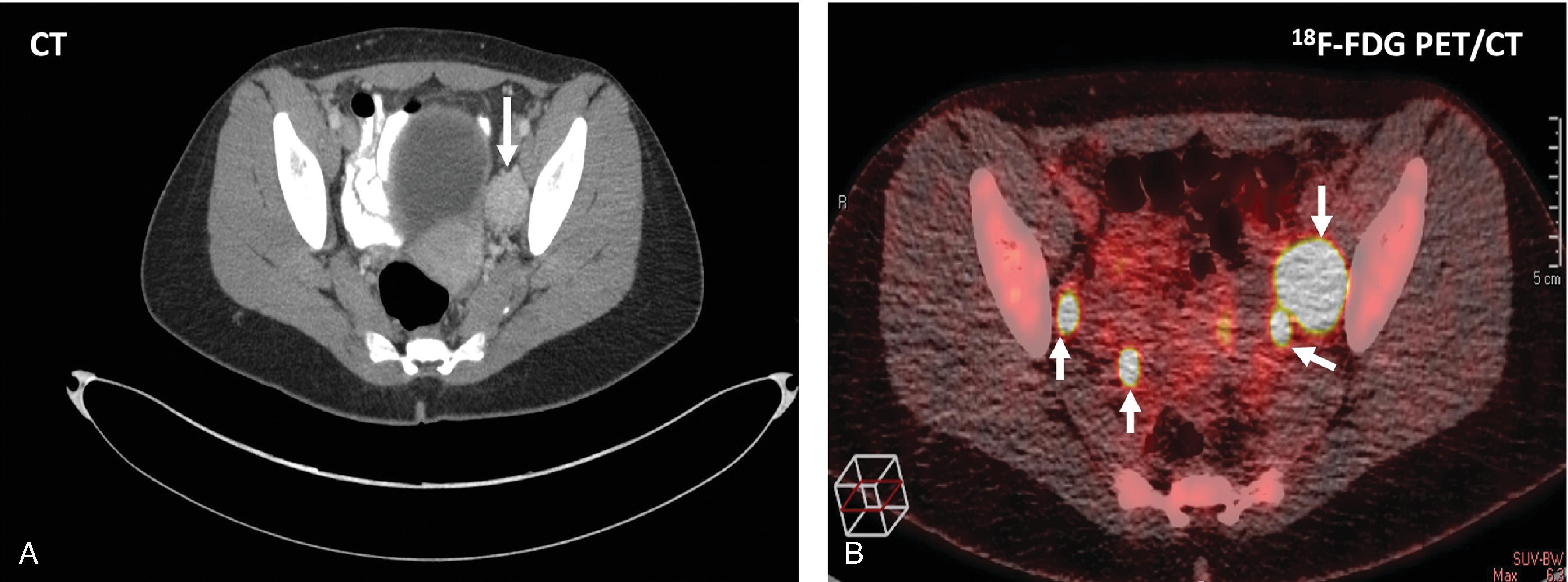 FIG. 3, CT scan (A) and 18 F-fluorodeoxyglucose (FDG) PET/CT scan (B) in a 16-year-old girl with a left functional paraganglioma. CT scan showed only the left paraganglioma (arrow) , but 18 F-FDG showed additional tumor adjacent to the mass (arrows) and on the right side of the pelvis .