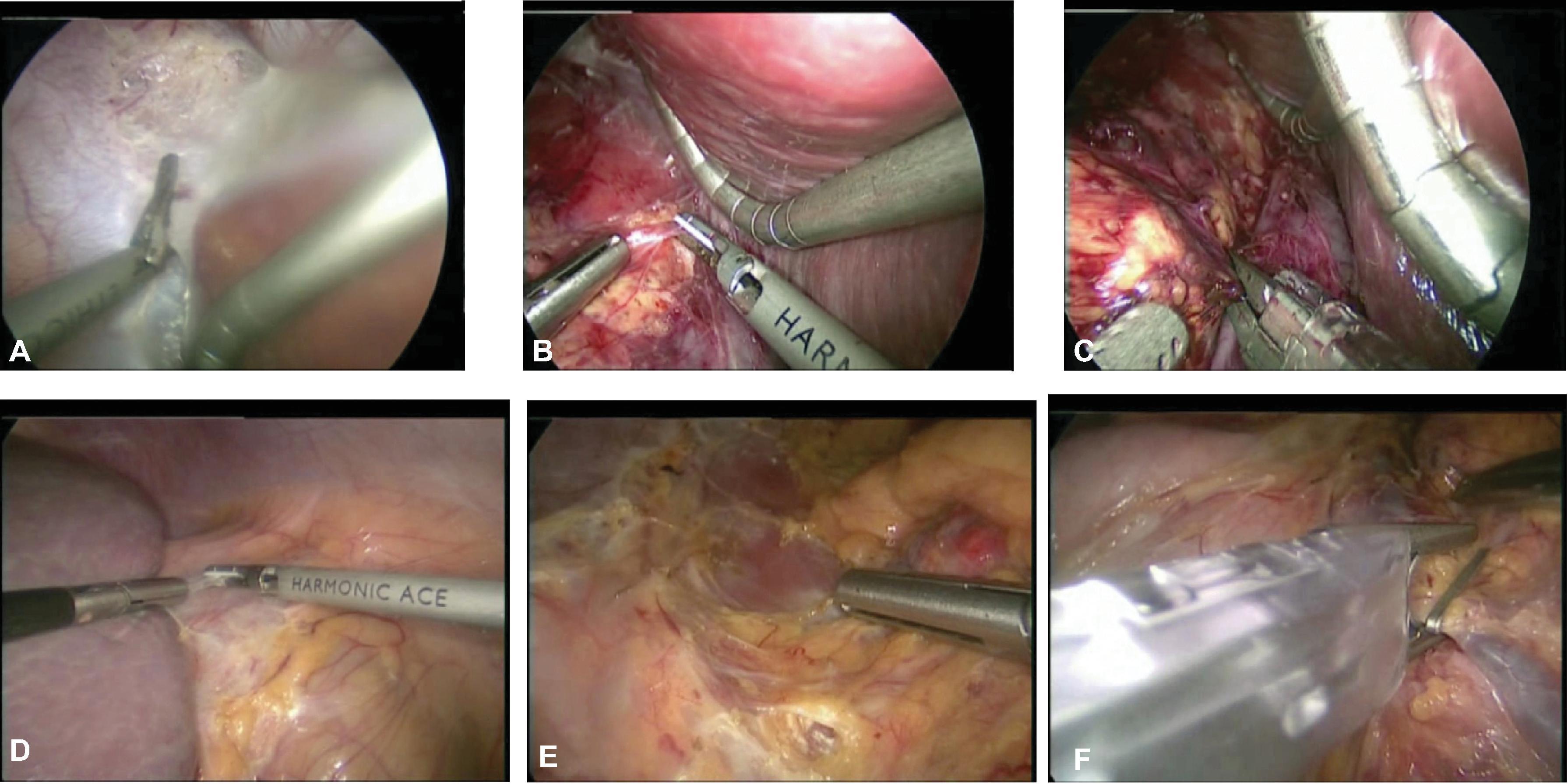 FIG. 4, Key steps in right lateral laparoscopic adrenalectomy. On the right side, (A) the triangular ligament is divided to mobilize the right lobe of the liver medially; (B) the adrenal gland and tumor are dissected from the top down along the medial edge after opening Gerota’s fascia; (C) the adrenal arteries (usually small) and the adrenal vein are encountered and the vein is clipped and divided. Adrenal pheochromocytoma may have multiple parasitic vessels. The inferior limb of the gland is carefully dissected free from the renal hilum and the renal vessels. The gland is then mobilized free from the kidney and retroperitoneal fat. The adrenal gland is placed in a bag and removed without morselization. On the left side, (D) the splenic flexure of the colon is mobilized free, as well as the lateral attachments of the spleen along the avascular space; (E) Gerota’s fascia is divided superior and medial to the adrenal gland and the dissection continued inferior; (F) often the inferior phrenic vein is identified along the medial aspect of the adrenal gland and can be traced down to the adrenal vein. The vein is clipped and divided. The inferior limb of the gland is carefully dissected free from the renal hilum and the renal vessels. The gland is then mobilized free from the kidney and retroperitoneal fat. The adrenal gland is removed in a bag.