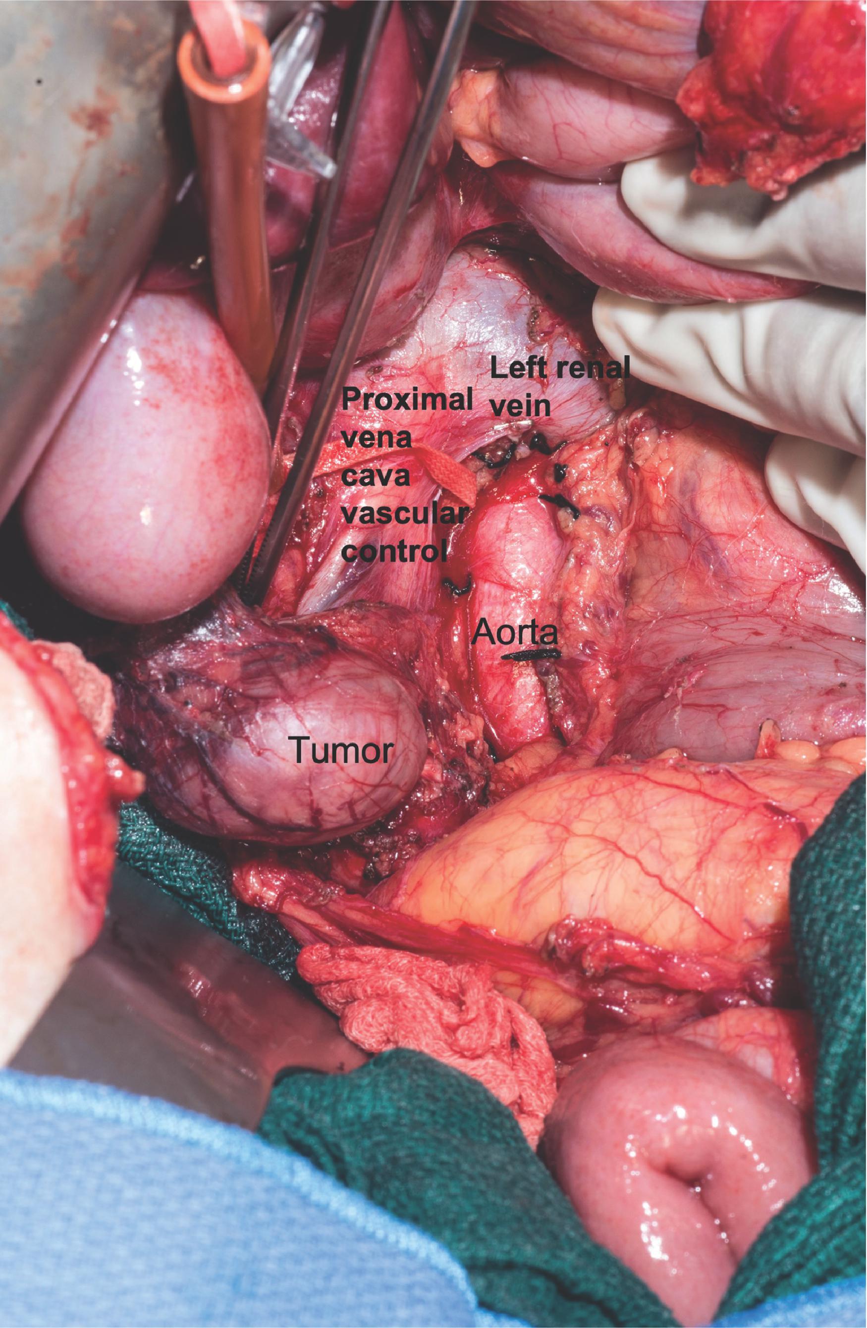 FIG. 6, Open resection of a right infrarenal pericaval paraganglioma after extended Kocher maneuver and proximal vena cava control.