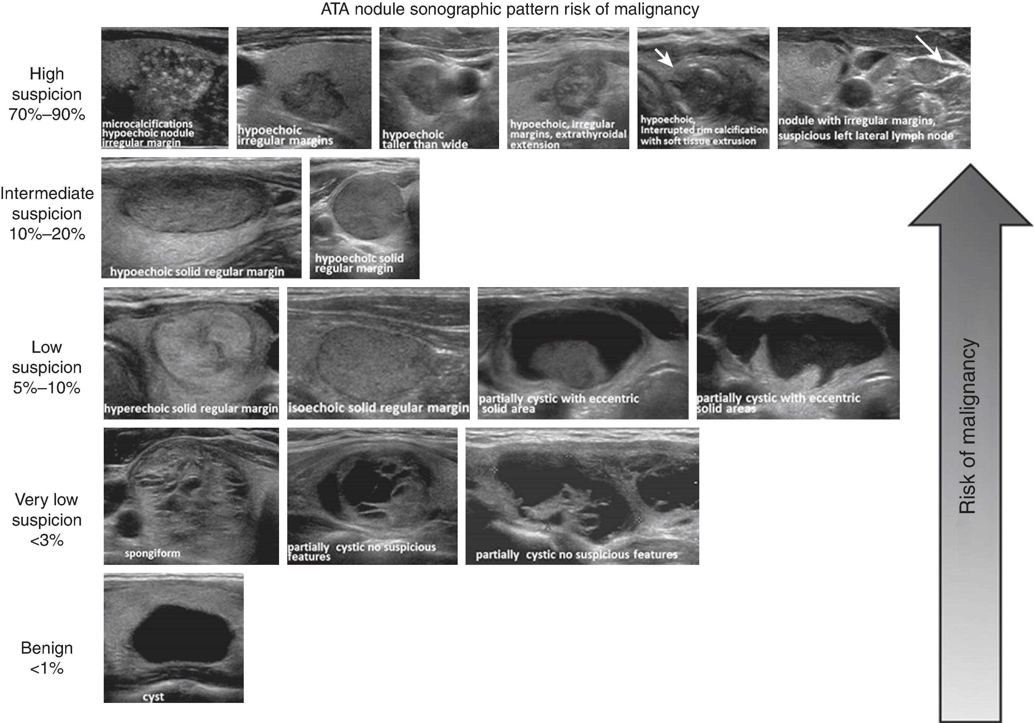 FIG. 1, American Thyroid Association (ATA) nodule sonographic pattern risk of malignancy.