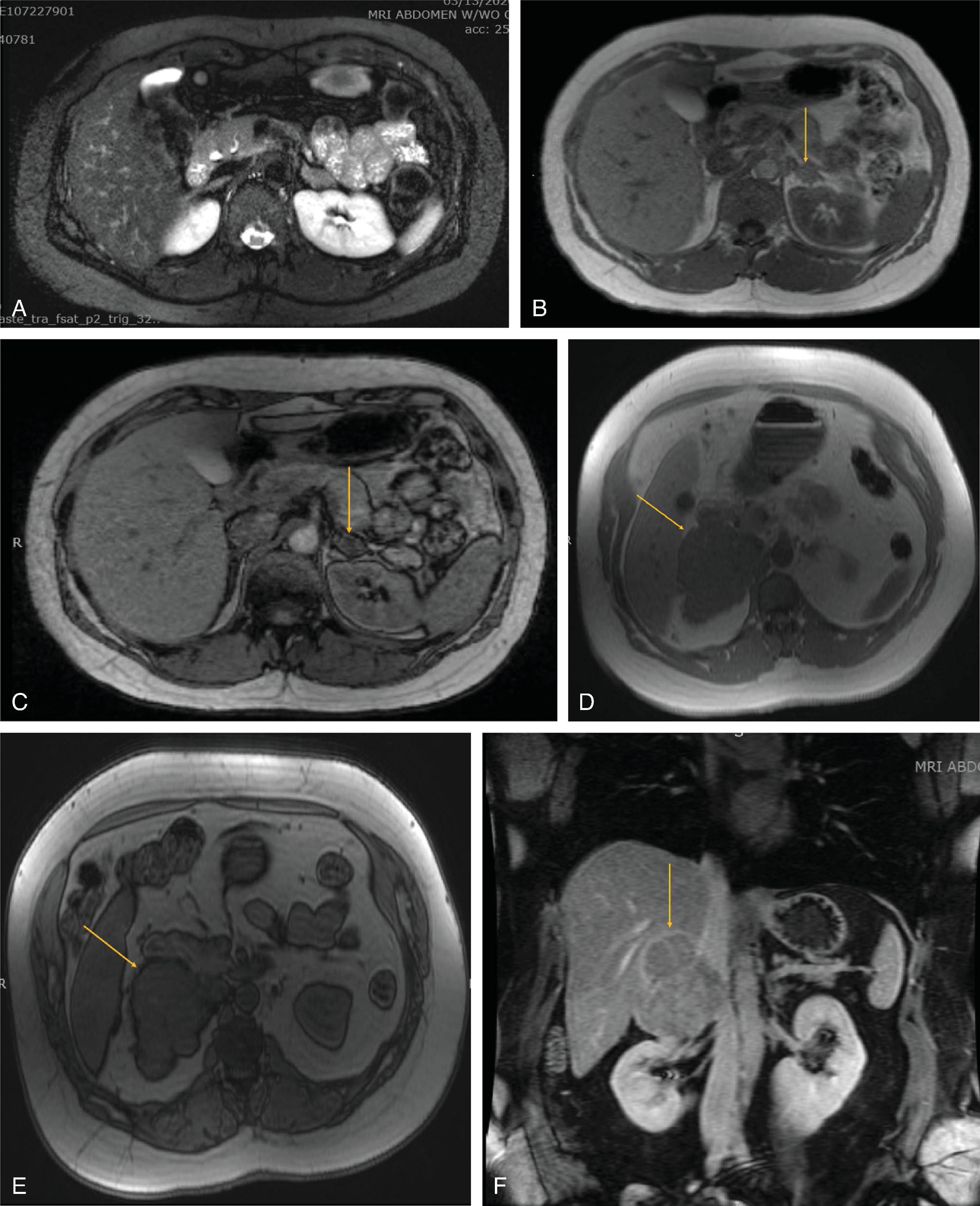 FIG. 2, In a patient with Cushing’s syndrome secondary to a benign cortisol-producing adenoma, T2-weighted image (A) demonstrates an isointense appearance of the nodule. T1-weighted images demonstrate loss of signal intensity shifting from in-phase (B) to out-of-phase (C). (D-F) MR images in a patient with right adrenocortical carcinoma. Compared with in-phase imaging ( D) , out-of-phase imaging (E) demonstrates no evidence of signal dropout to suggest that this lesion contains fat. Postcontrast MRI imaging (F) demonstrates heterogeneous enhancement. There is mass effect on the adjacent inferior vena cava without discrete infiltration of the inferior vena cava.