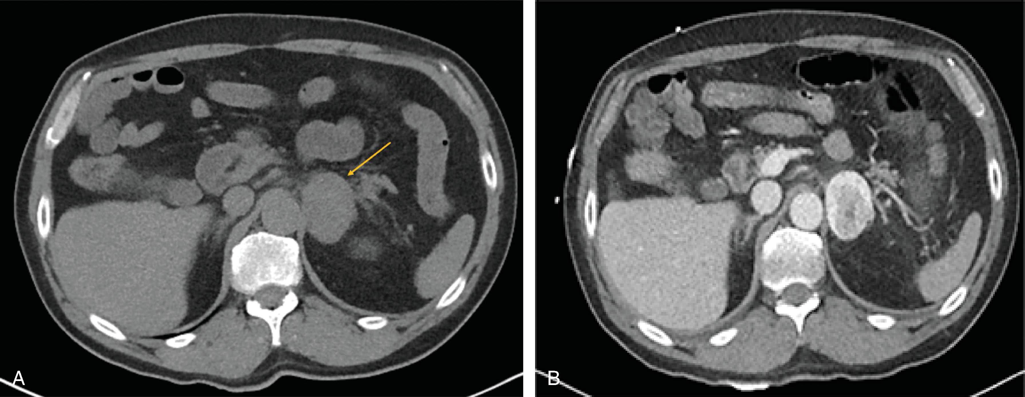 FIG. 3, Classic CT scan findings in a patient with a left pheochromocytoma. The left adrenal mass is well circumscribed; compared with the noncontrast image (A), it is heterogeneous and strongly enhances on arterial phase (B) with increased attenuation at the periphery, suggestive of a pheochromocytoma.