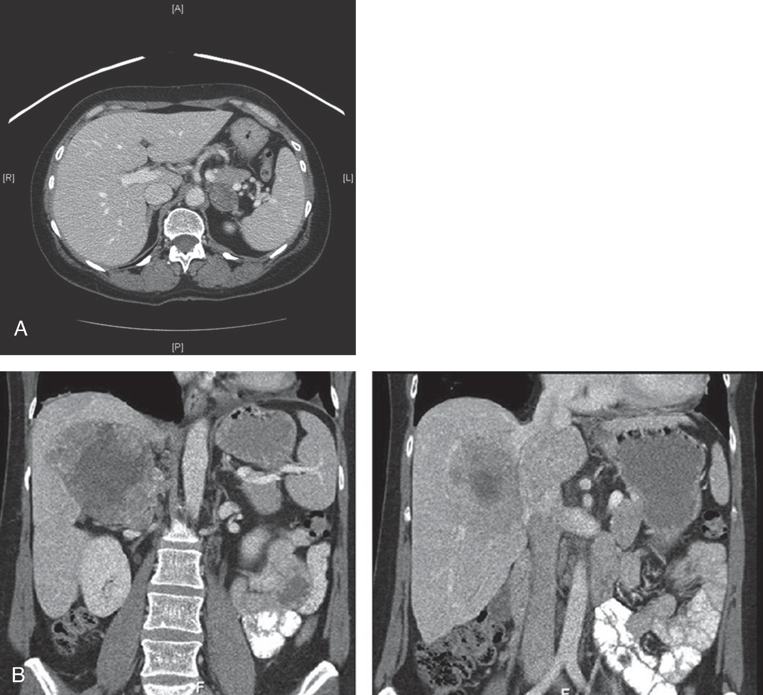 FIG. 2, Adrenal cortical lesions on CT imaging can appear (A) benign, hypodense compared with normal adrenal tissue, and generally contained to the adrenal gland, or (B) malignant, with areas of hyperintensity and invasion into surrounding structures (such as the liver and retrohepatic inferior vena cava in this example).