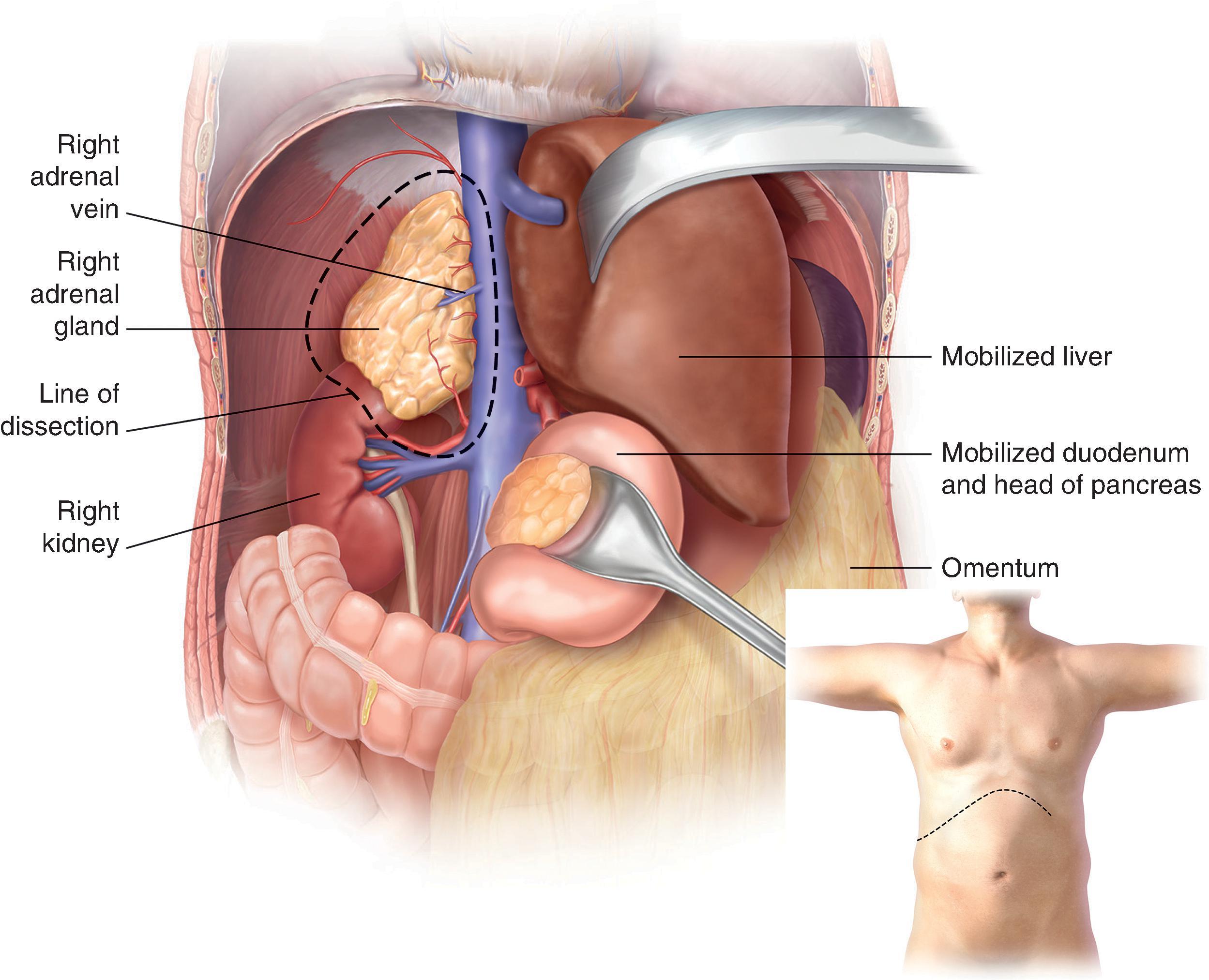 FIG. 3, Exposure of the right and left adrenal glands via an open abdominal approach.