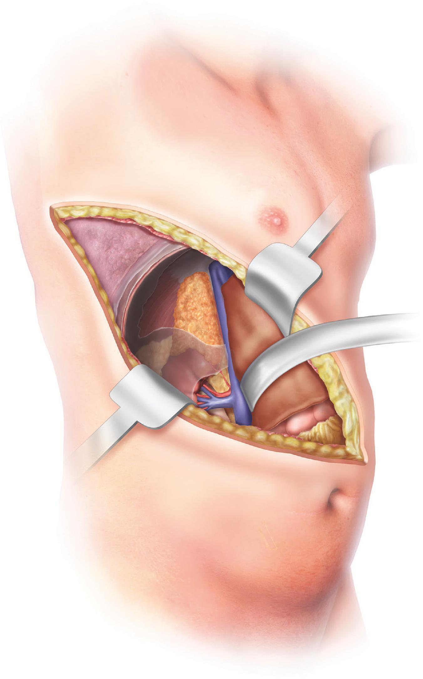 FIG. 4, Exposure of the right adrenal gland via a thoracoabdominal approach.