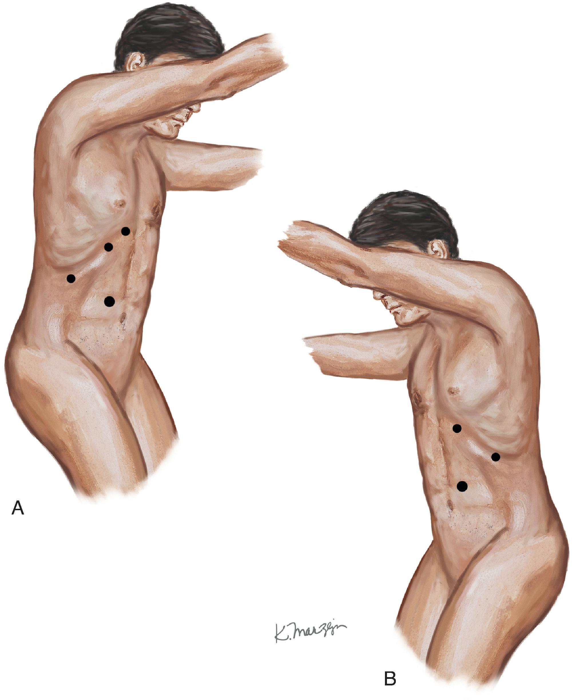 FIG. 5, Patient positioning and port placement for (A) right-sided and (B) left-sided laparoscopic transabdominal adrenalectomies. Although not indicated in the figure, the sub-xiphoid port can be used in a left-sided approach to aid with retraction of the spleen and tail of the pancreas.