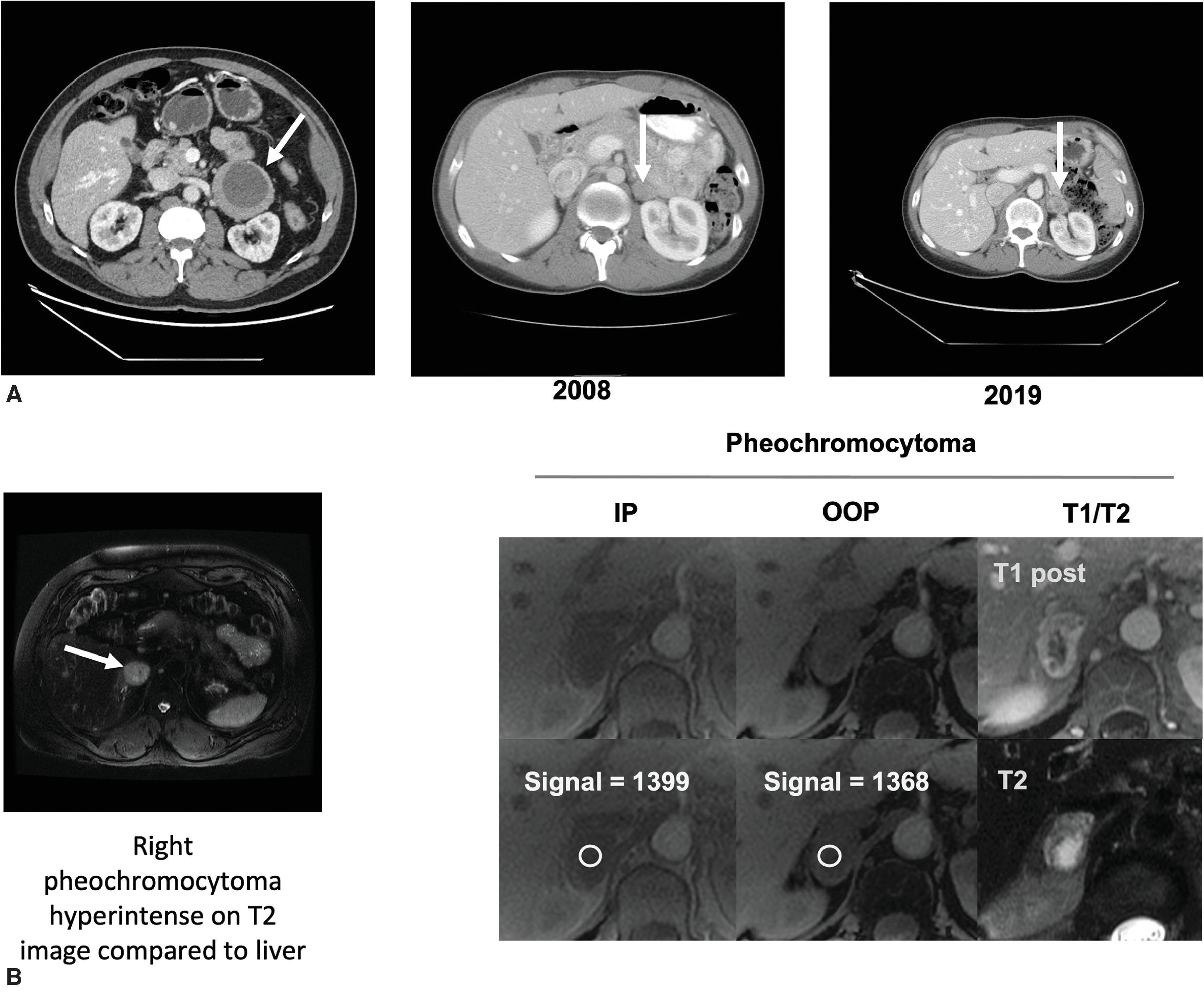 FIG. 1, Anatomic imaging of pheochromocytoma. (A) CT scan of the abdomen with intravenous contrast shows a left sided pheochromocytoma that has a central area of necrosis and peripheral enhancement (left panel, arrow showing mass). CT scan of the abdomen in a patient who was found to have an adrenal incidentaloma in 2019 (right panel, arrow showing mass) with biochemical testing showing elevated normetanephrine and metanephrine. The tumor is a heterogenous mass, but there was no change in tumor size when compared with an older CT scan in the same patient done in 2008 (middle panel, arrow showing mass). (B) MRI of the abdomen on fat-suppressed T2-weighted image shows right-sided pheochromocytoma that is hyperintense (left panel, arrow showing mass). MRI showing a right adrenal pheochromocytoma in phase (IP), out of phase (OOP), and on T1 and T2 (right panel).