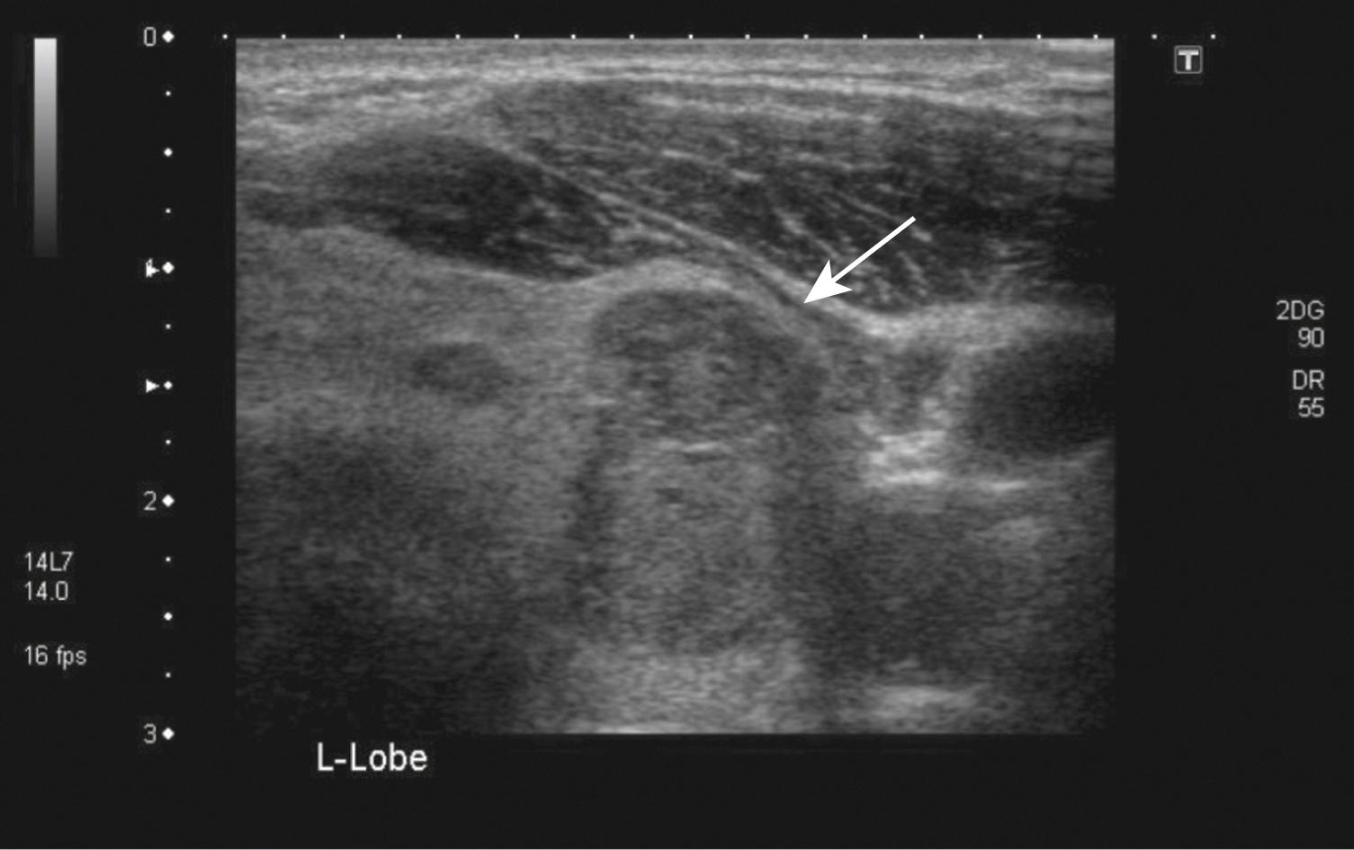 Fig. 21.4, Ultrasound demonstrating thyroid nodule.