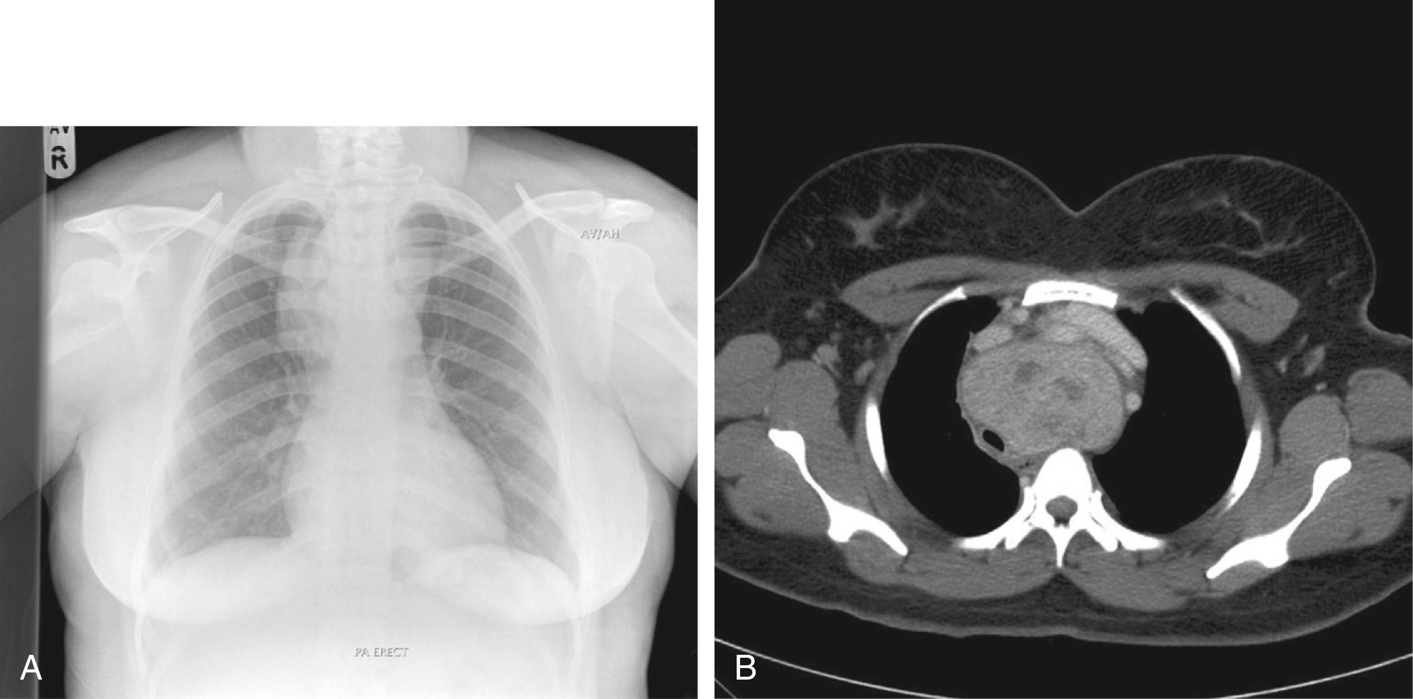 Fig. 21.6, Retrosternal goitre images showing marked tracheal deviation.
