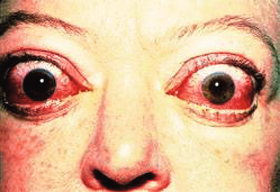 Fig. 21.8, Thyroid-associated ophthalmopathy.