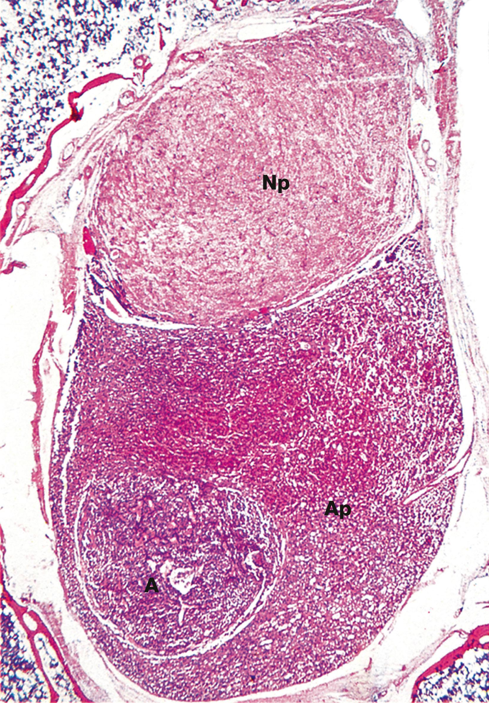 E-Fig. 17.1, Pituitary adenoma (LP)
