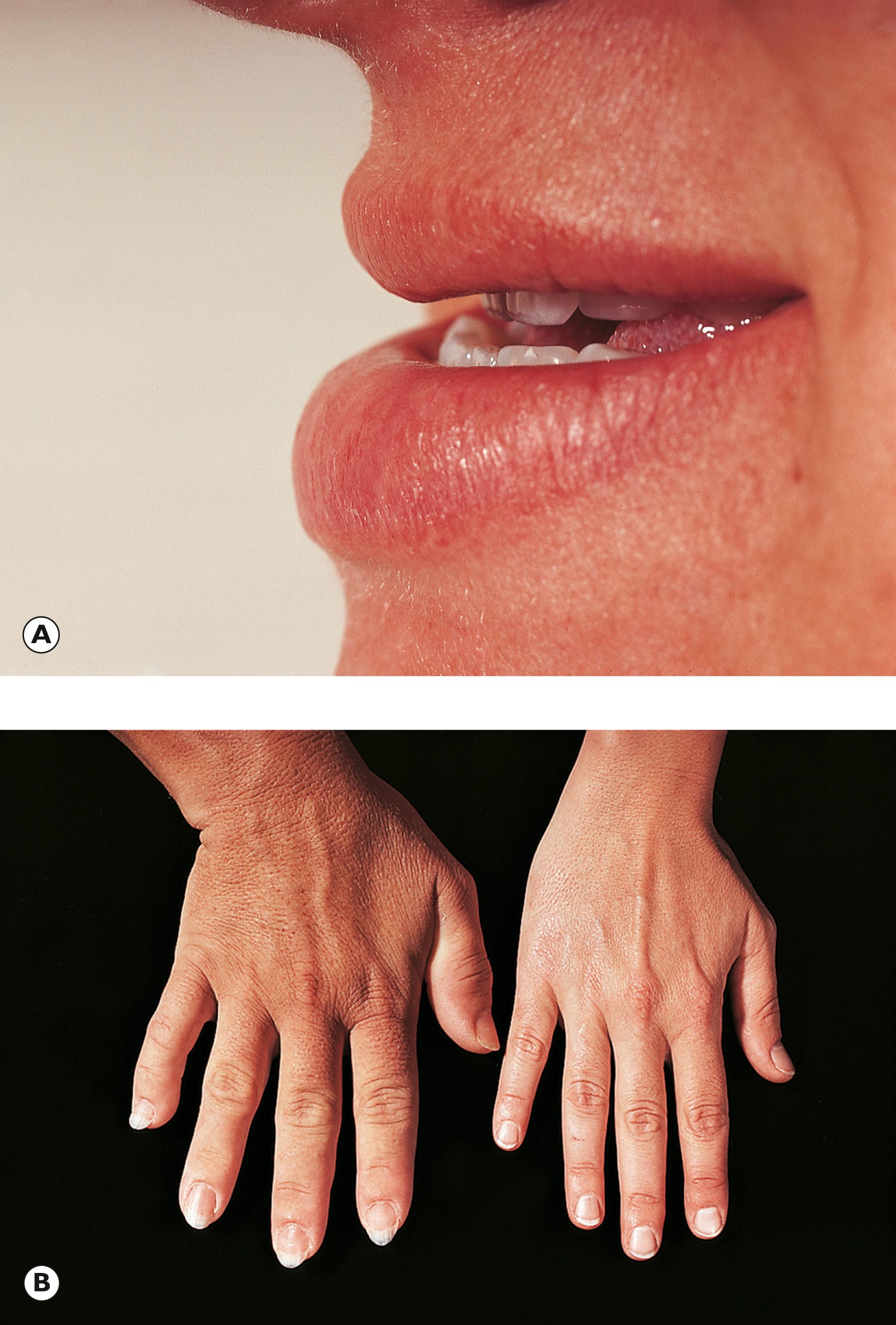 E-Fig. 20.1 G, Acromegaly, typical clinical manifestations. (A) Malocclusion of the teeth caused by overgrowth of the mandible. The patient had noted her facial appearance had been changing. (B) The hand on the left of the image belongs to the same patient. This has an enlarged ‘spade-like’ appearance in contrast to the healthy hand seen on the right of the image.