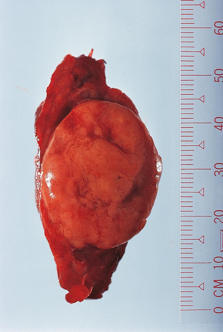 E-Fig. 20.3 G, Follicular adenoma. A lobe of thyroid has been dissected to reveal a well circumscribed tan nodule, a follicular adenoma. Careful sampling of the interface between the edge of the lesion and the adjacent thyroid is required to look for any microscopic foci of capsular or vascular invasion that could indicate a minimally invasive follicular carcinoma.