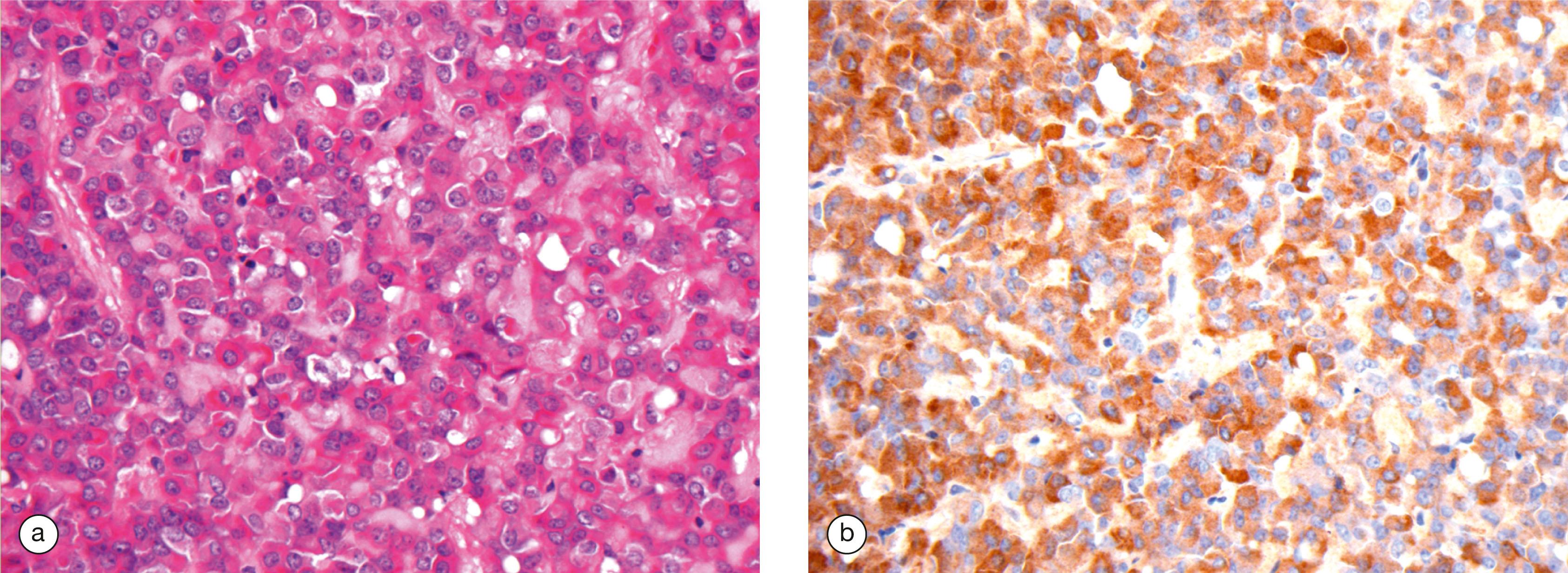 E-Fig. 17.2, Pituitary adenoma