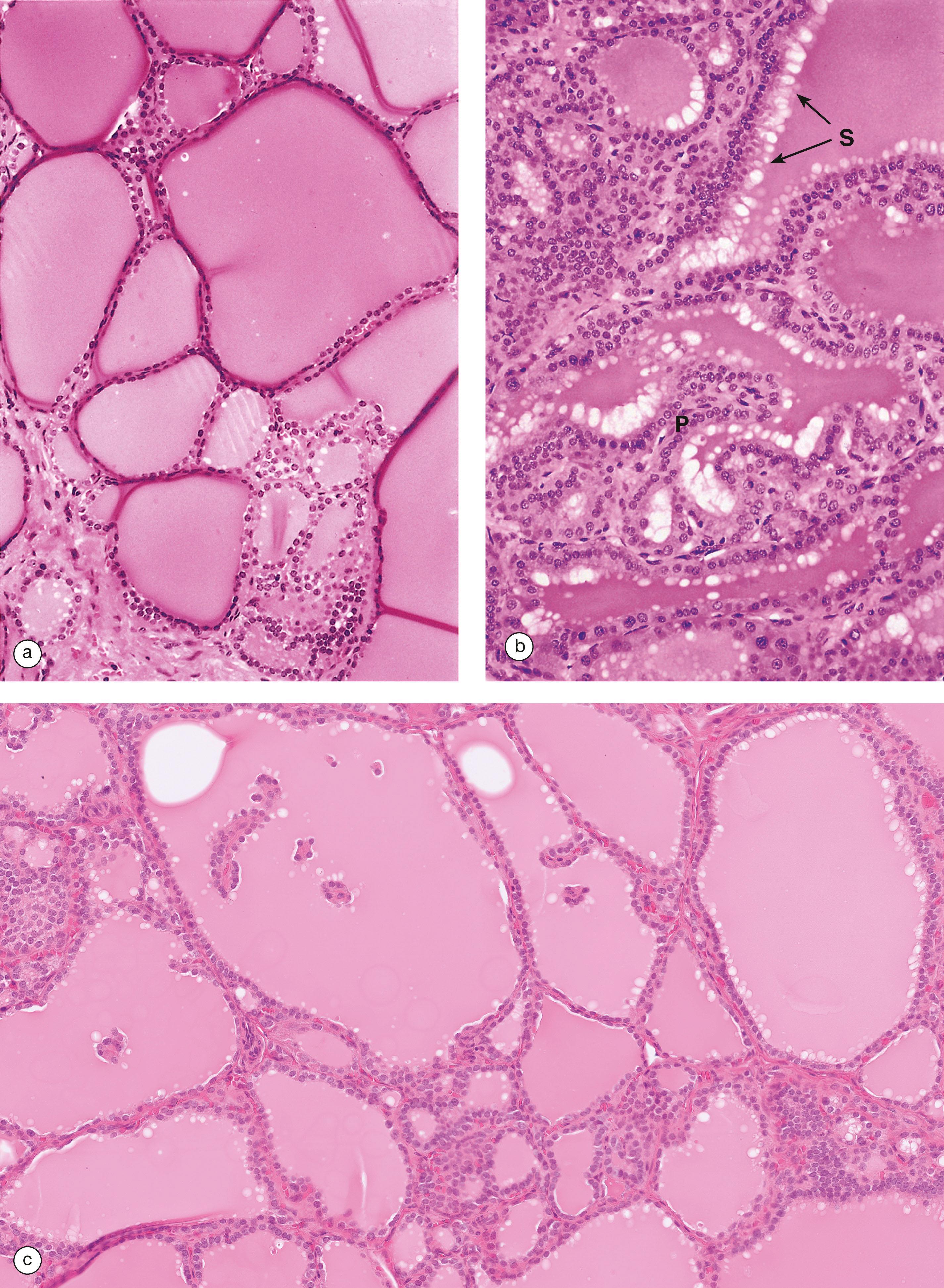 E-Fig. 17.3, Graves’ disease