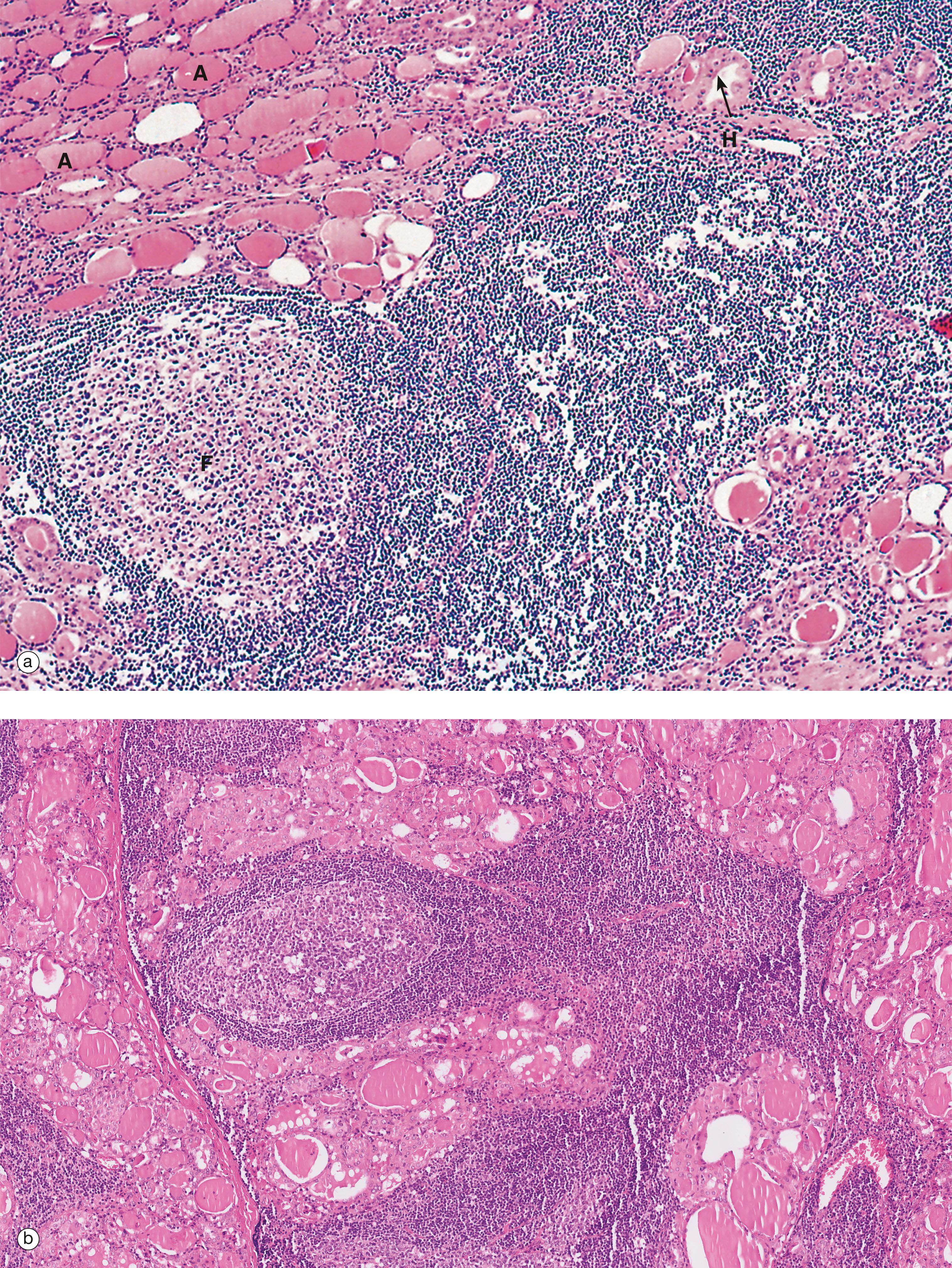 E-Fig. 17.4, Hashimoto’s thyroiditis (MP)