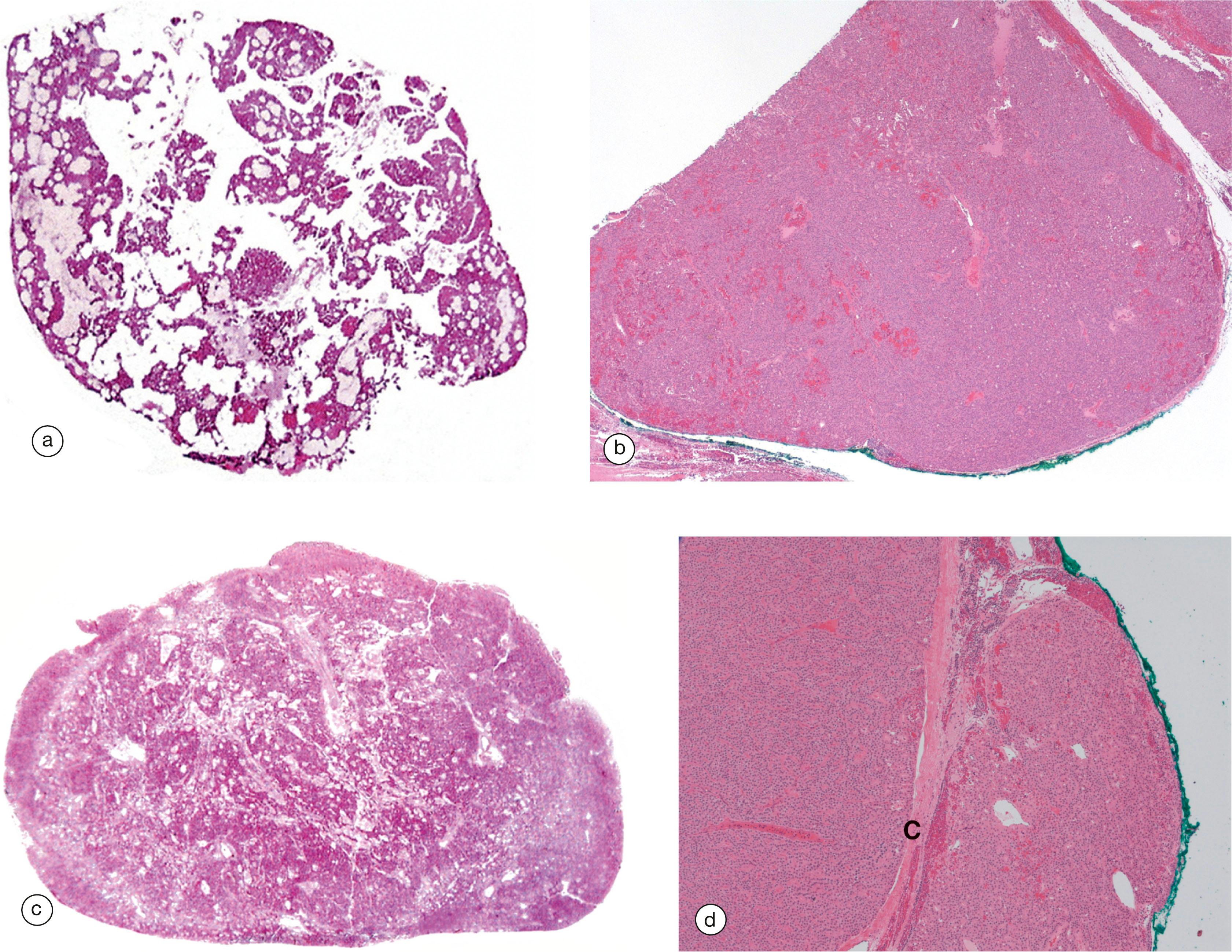 E-Fig. 17.5, Parathyroid hyperplasia, adenoma and carcinoma